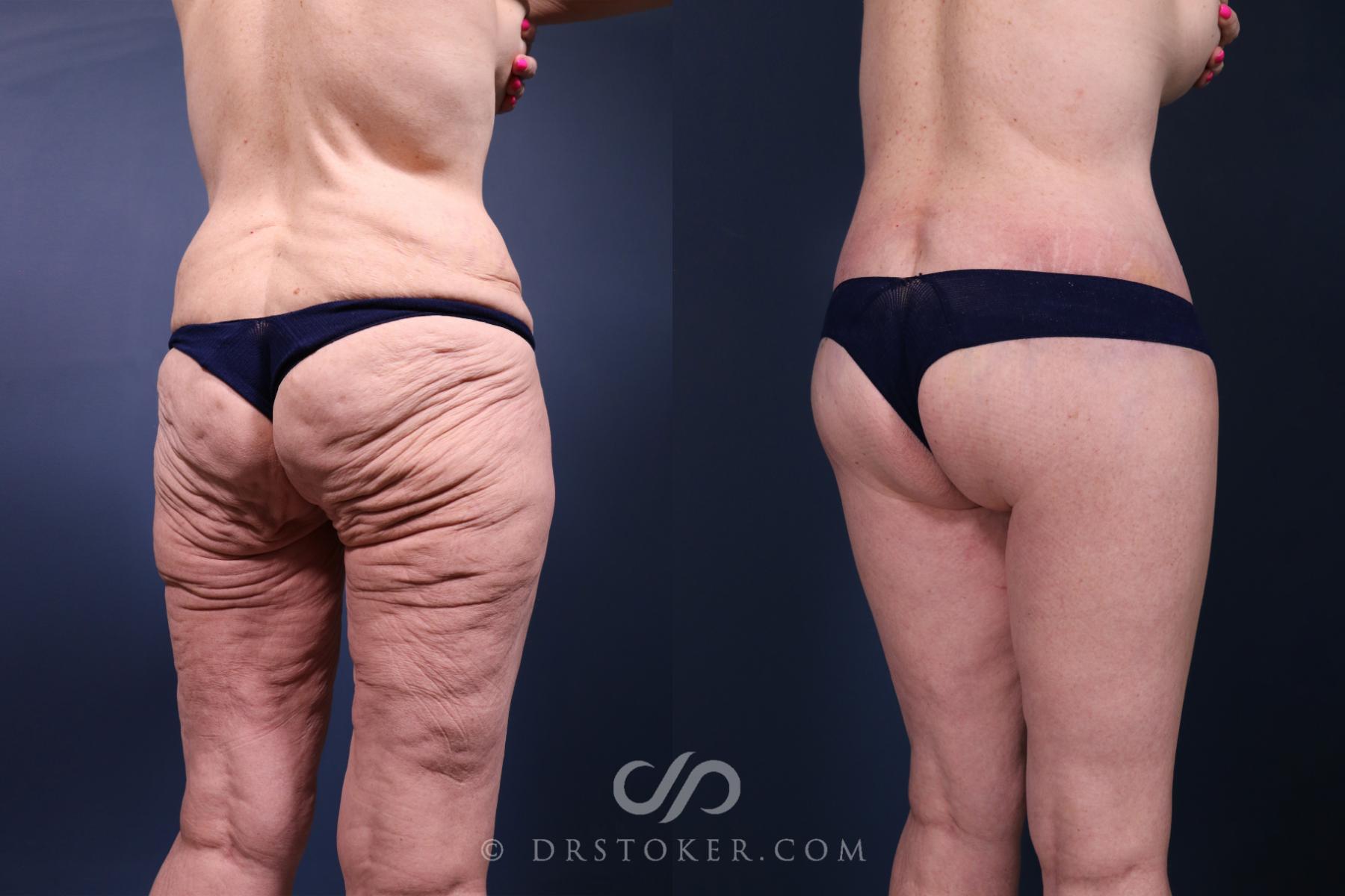 Before & After Lower Body Lift Case 2348 Right Oblique View in Los Angeles, CA