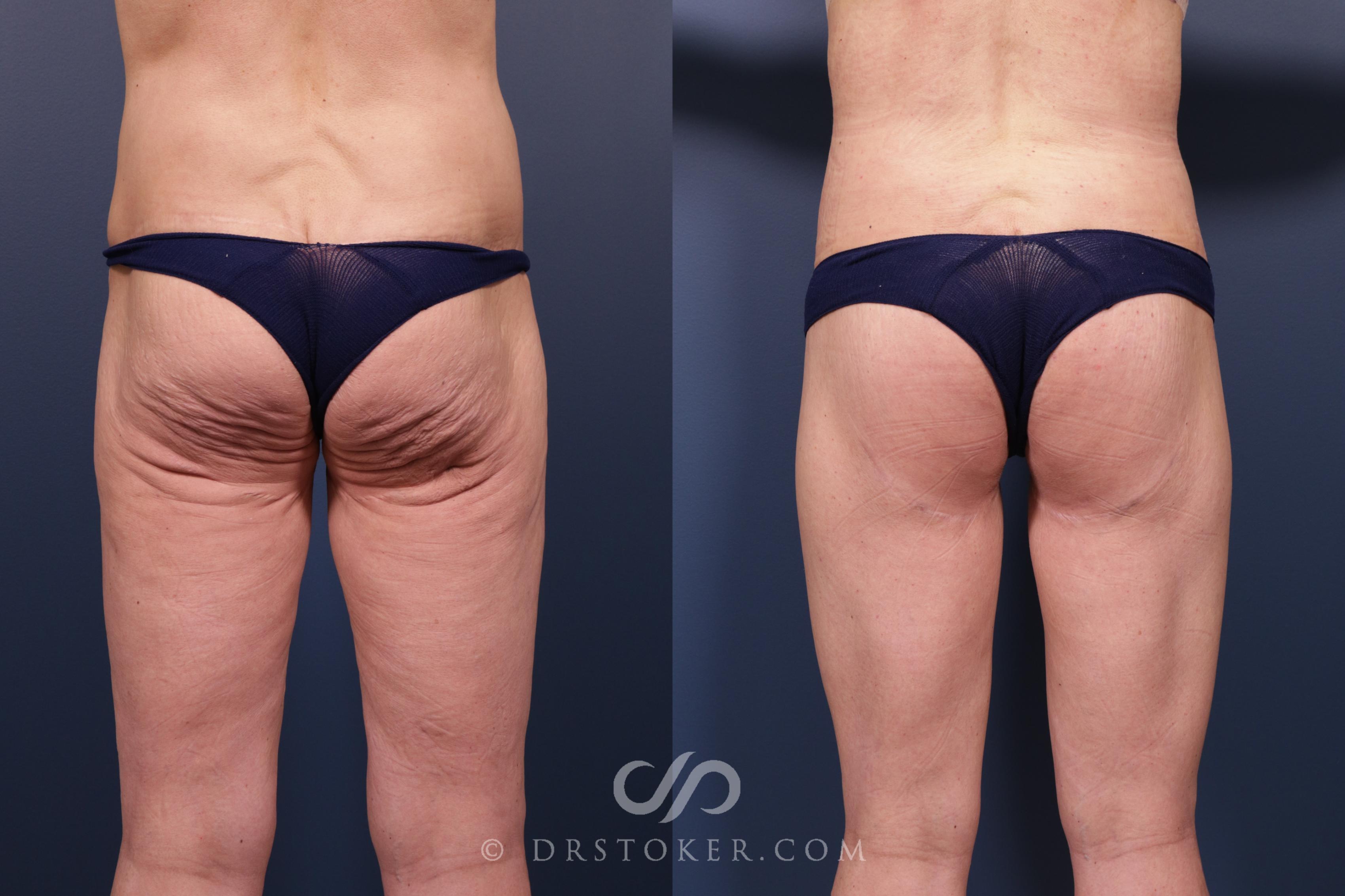 Before & After Lower Body Lift Case 2350 Back View in Los Angeles, CA