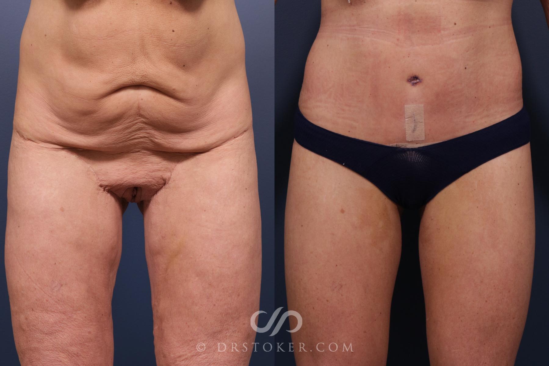 Before & After Lower Body Lift Case 2350 Left Oblique View in Los Angeles, CA