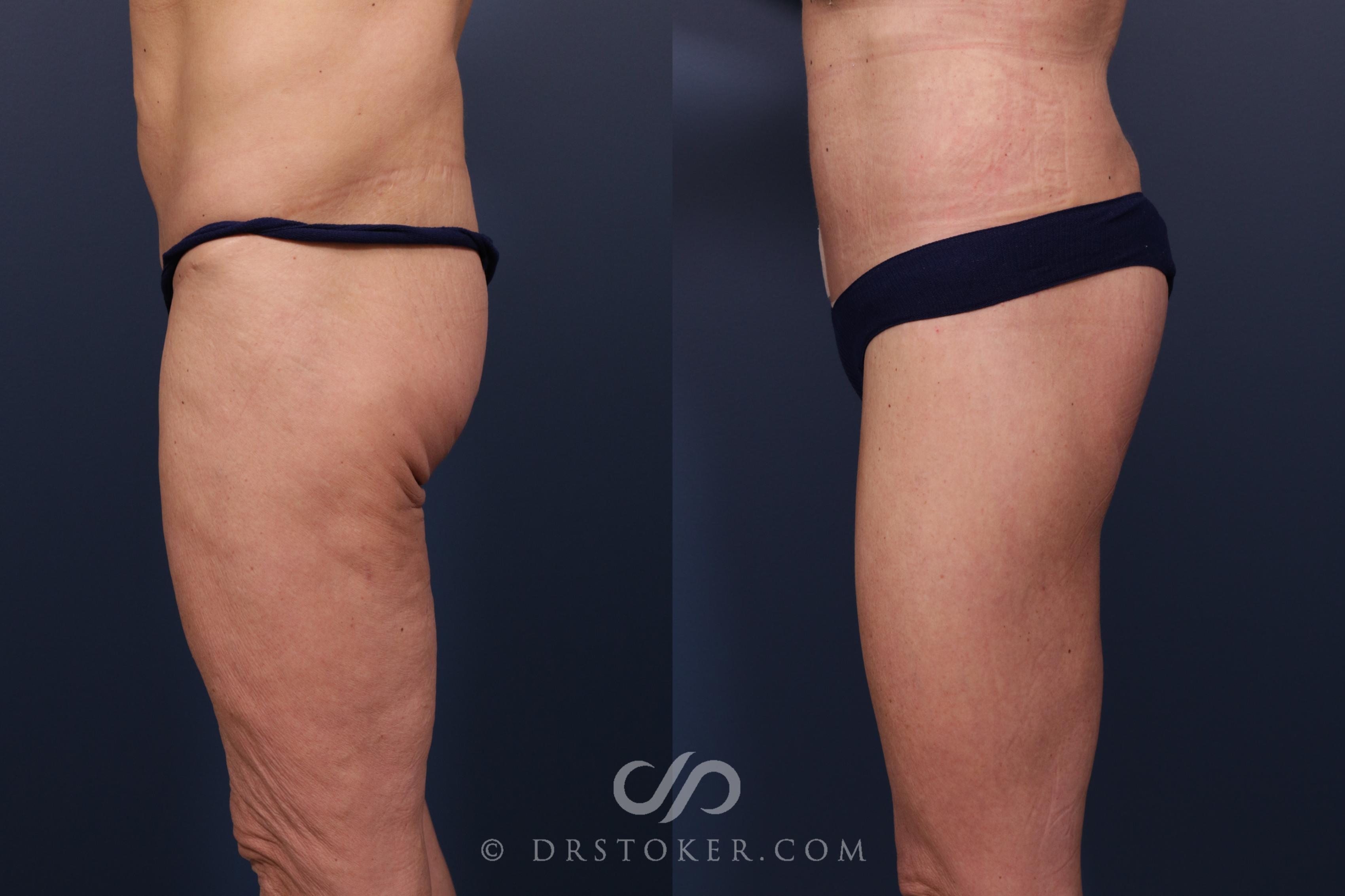 Before & After Lower Body Lift Case 2350 Left Side View in Los Angeles, CA