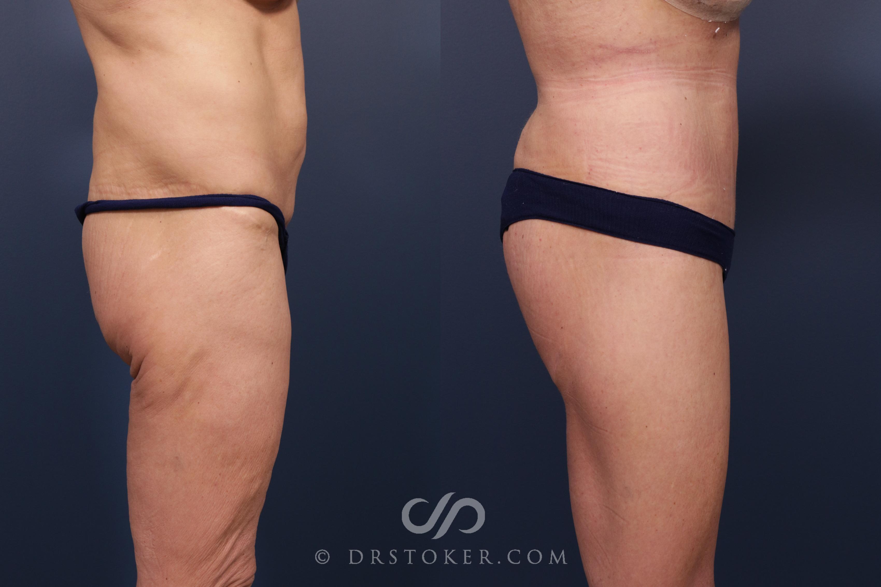 Before & After Lower Body Lift Case 2350 Right Side View in Los Angeles, CA