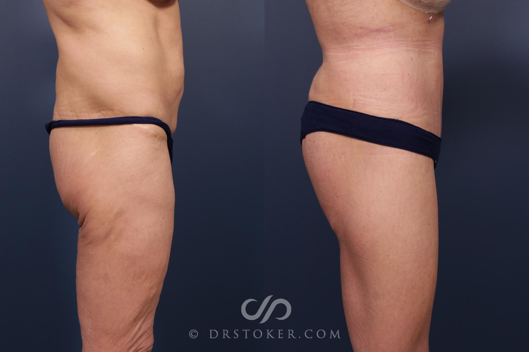 Before & After Lower Body Lift Case 2350 Right Side View in Los Angeles, CA