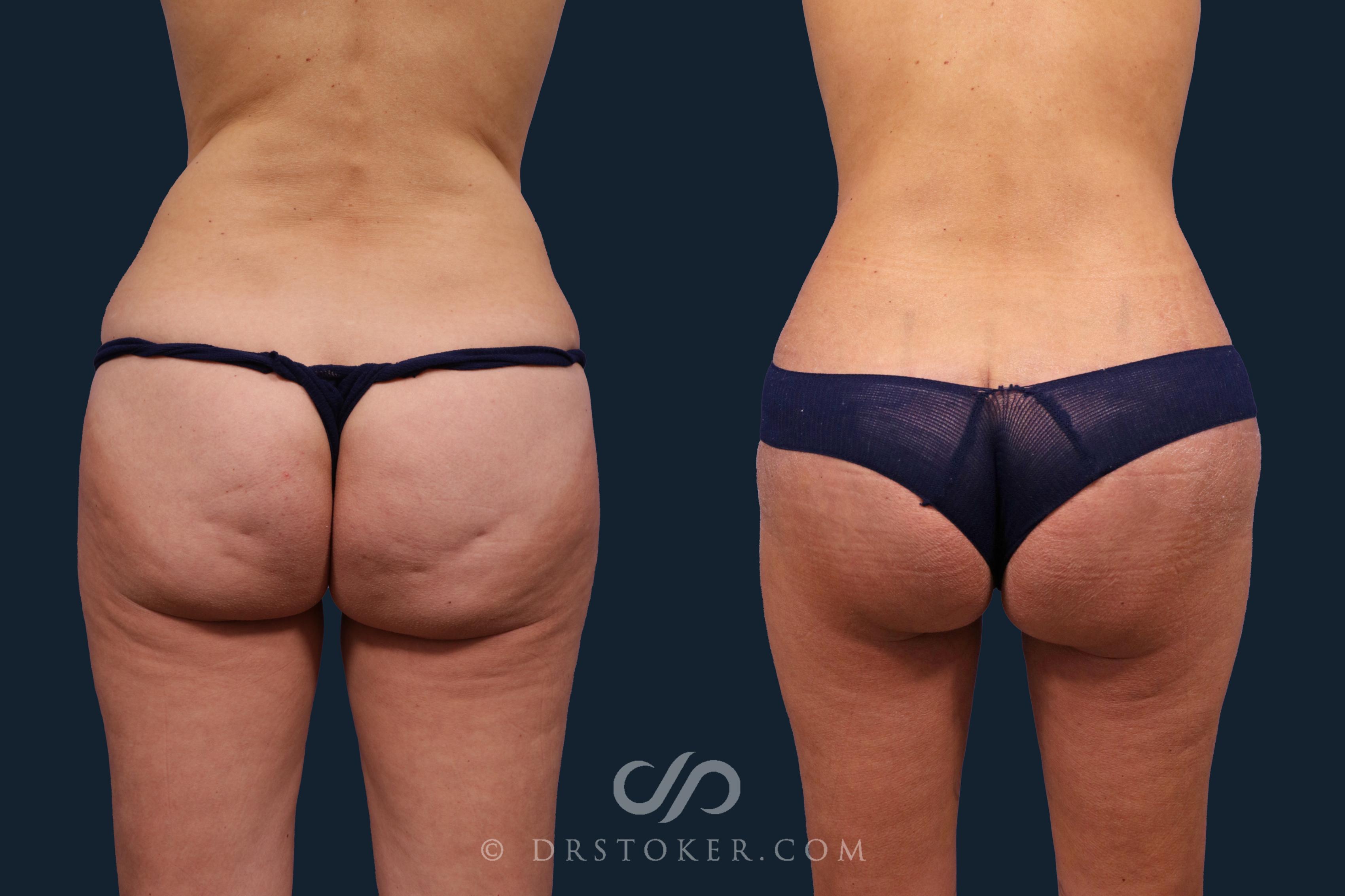 Before & After Lower Body Lift Case 2351 Back View in Los Angeles, CA