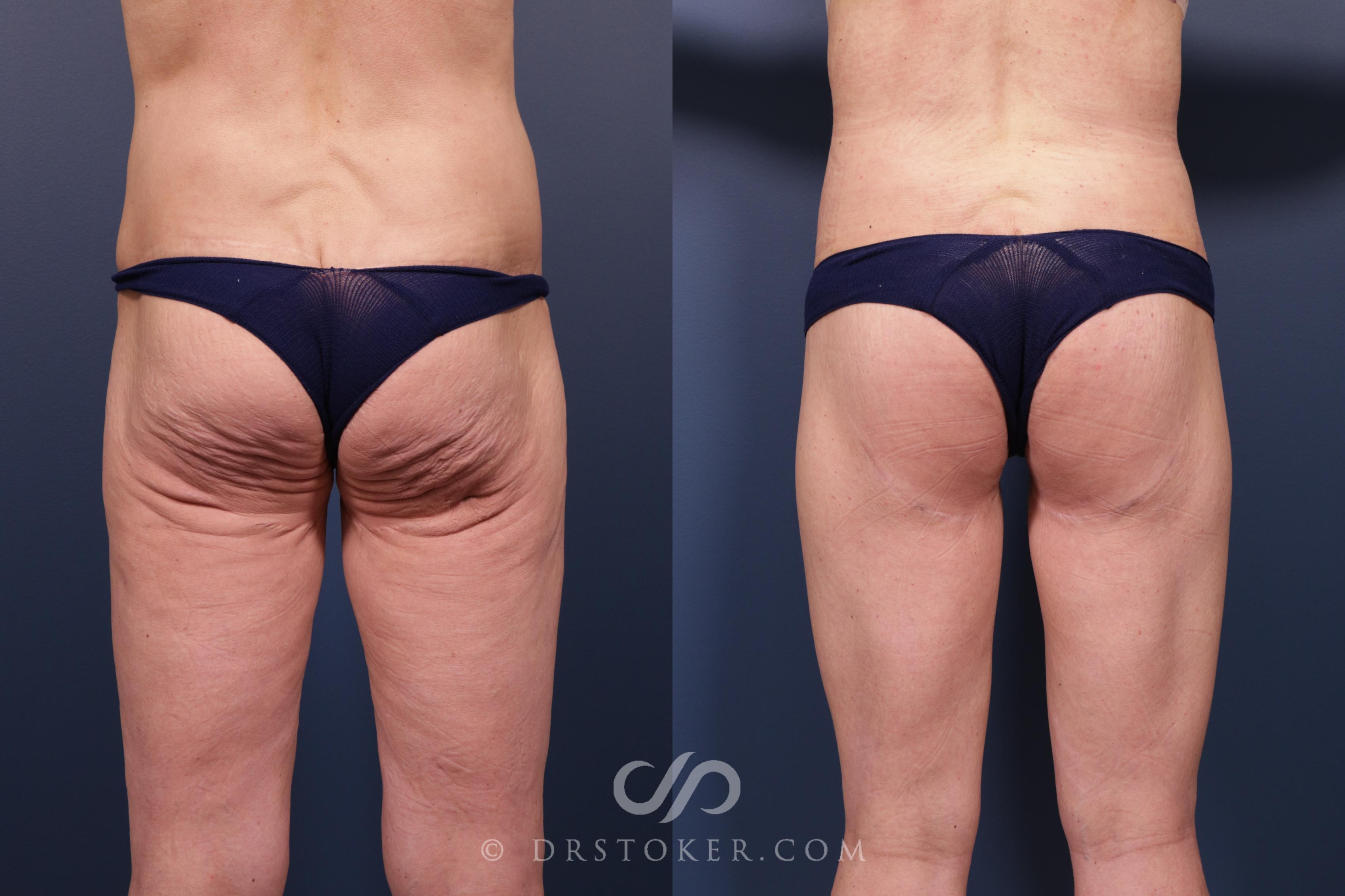 Before & After Lower Body Lift Case 2379 Back View in Los Angeles, CA