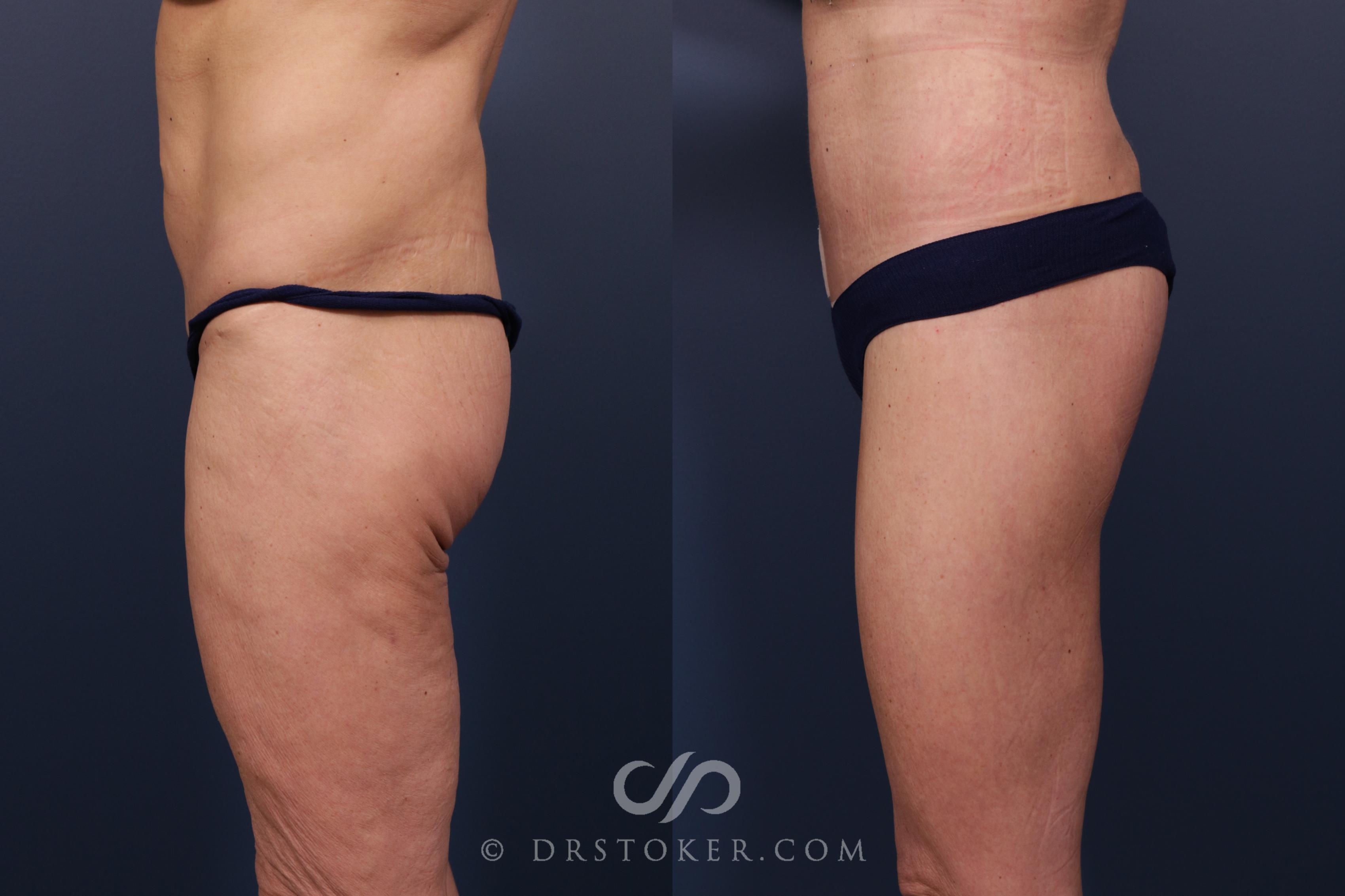 Before & After Lower Body Lift Case 2379 Left Side View in Los Angeles, CA
