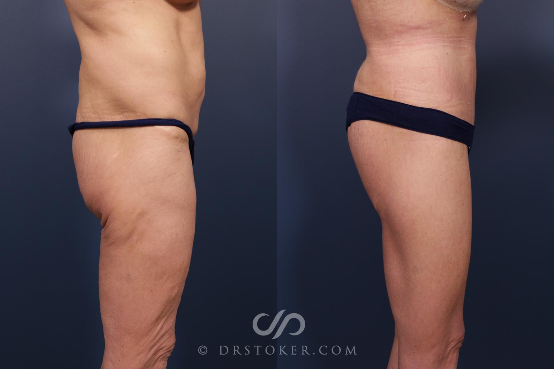 Before & After Lower Body Lift Case 2379 Right Side View in Los Angeles, CA