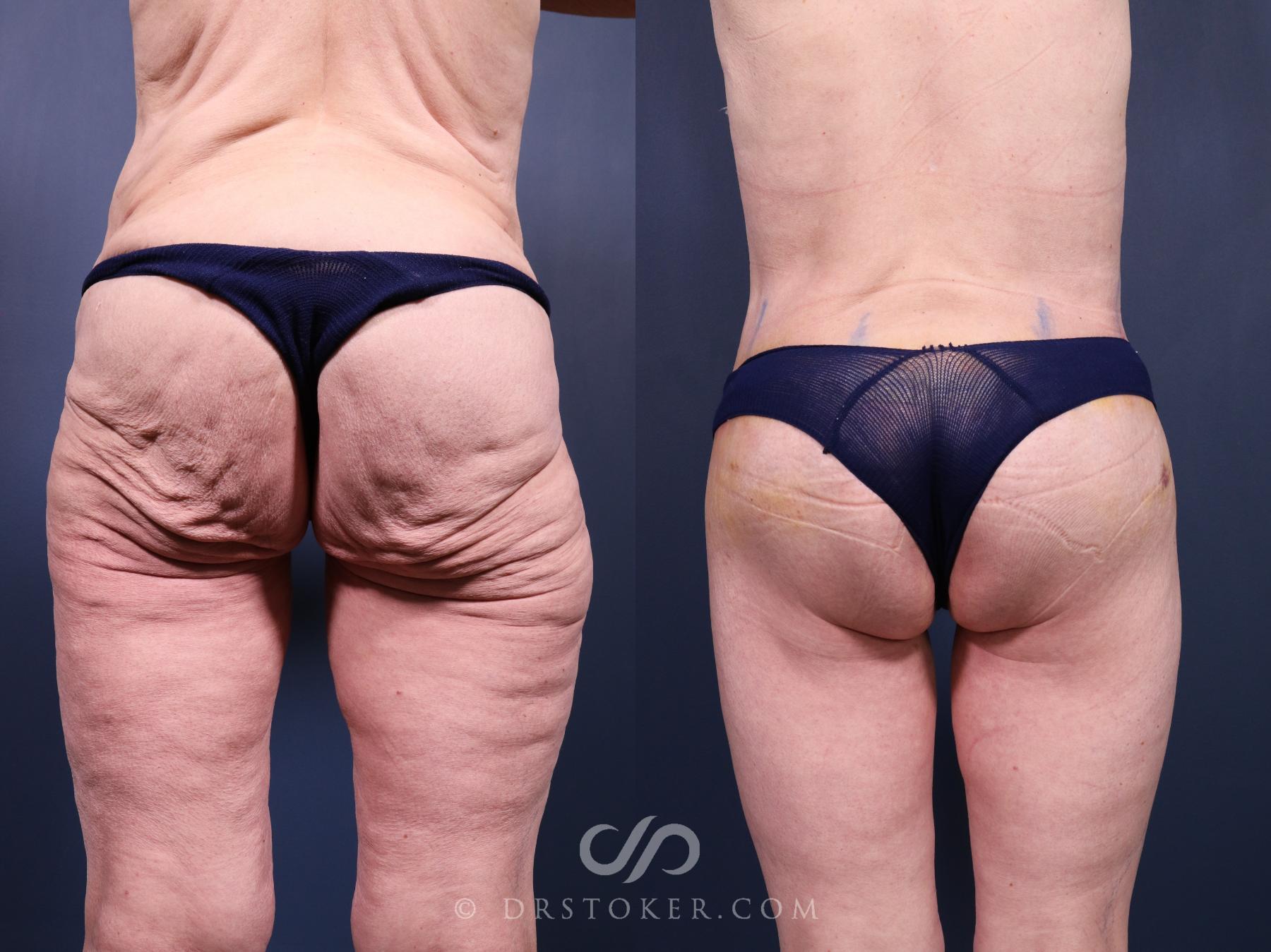 Before & After Bikini Body Lift Case 2381 Back View in Los Angeles, CA