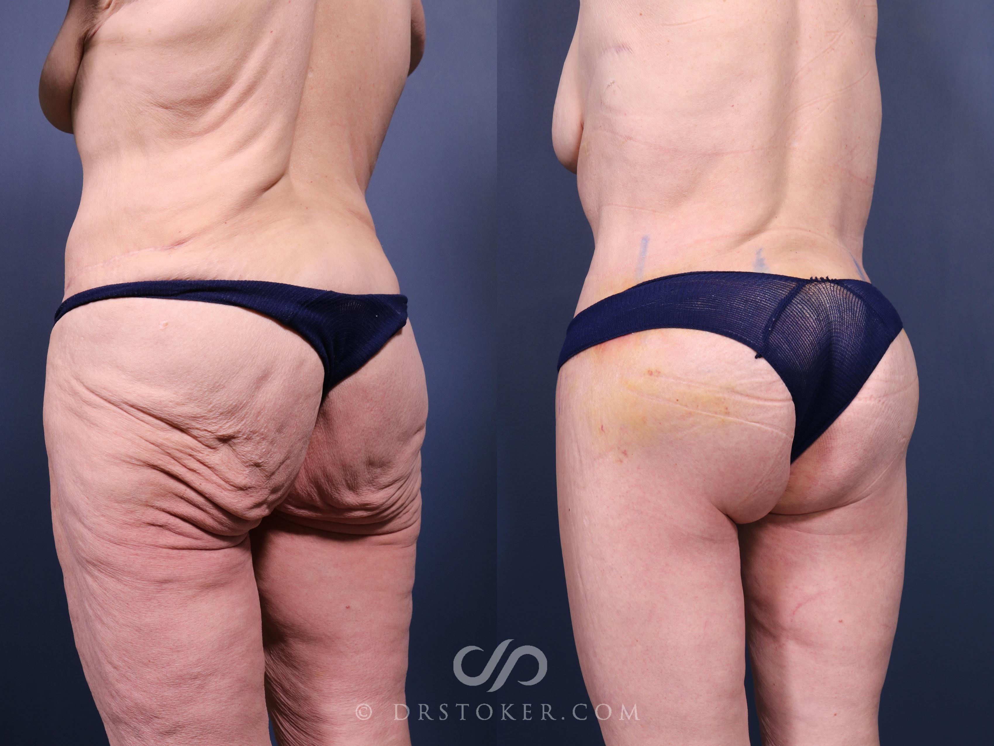 Before & After Bikini Body Lift Case 2381 Left Oblique View in Los Angeles, CA