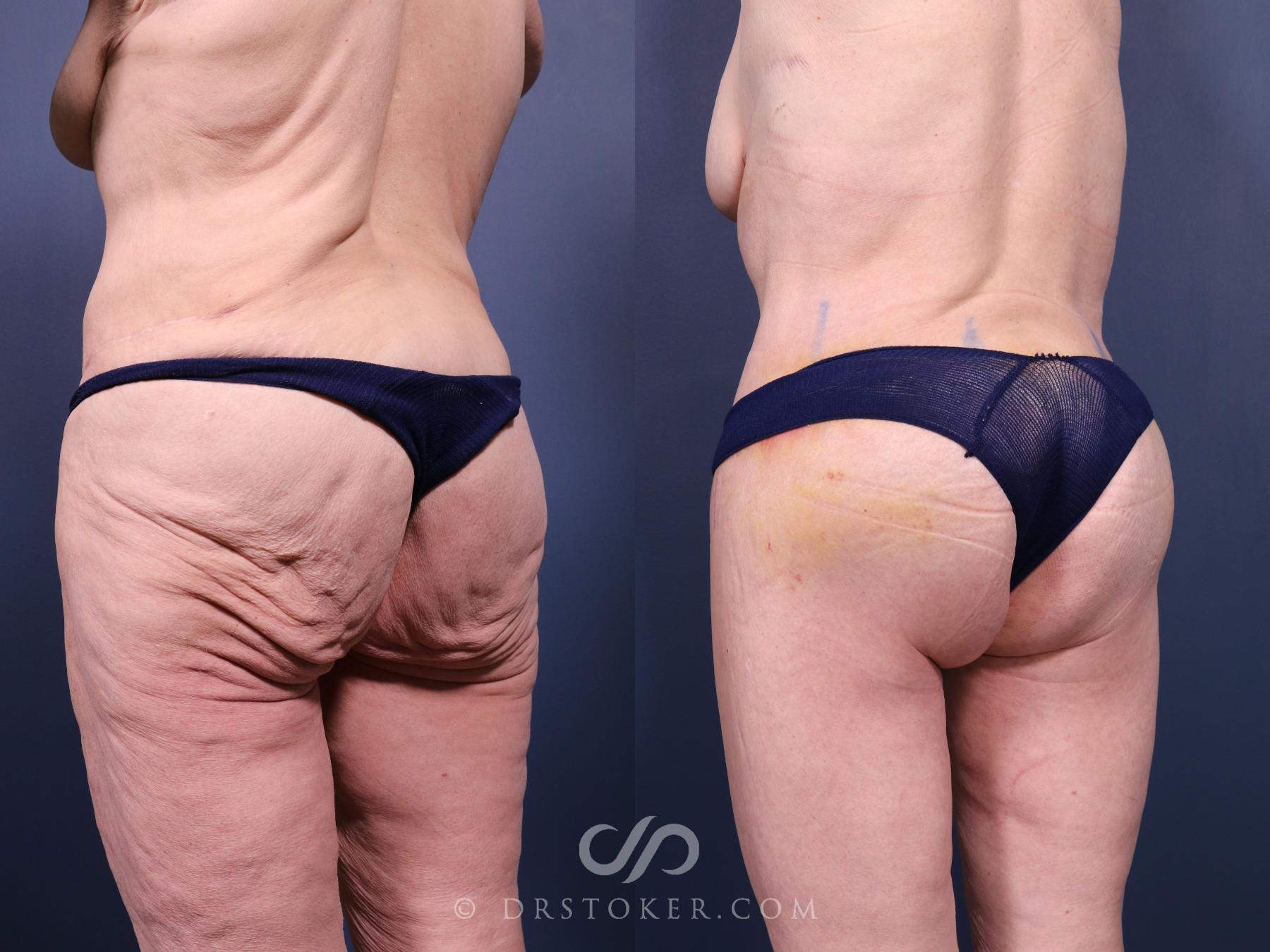 Before & After Bikini Body Lift Case 2381 Left Oblique View in Los Angeles, CA