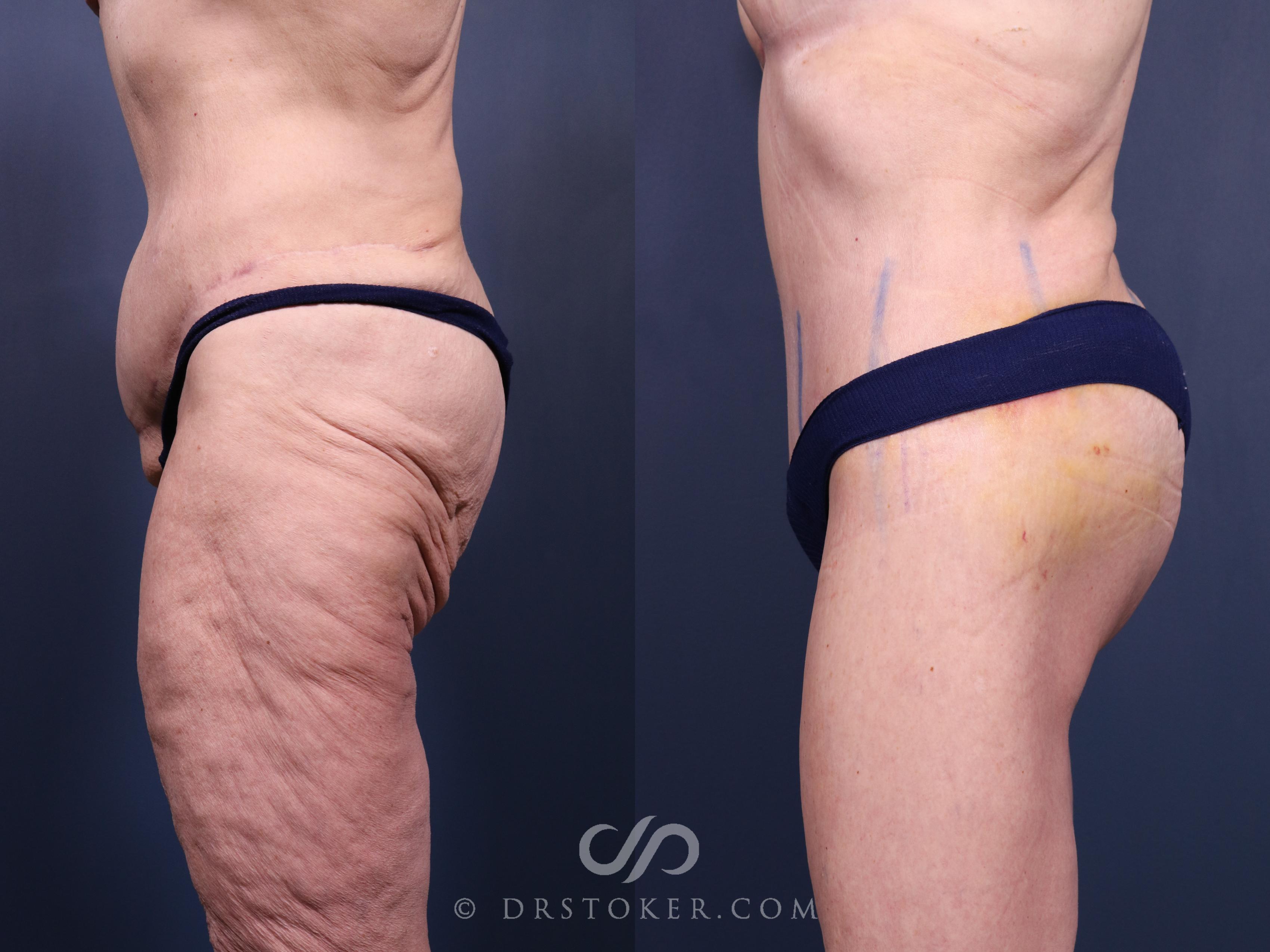 Before & After Bikini Body Lift Case 2381 Left Side View in Los Angeles, CA