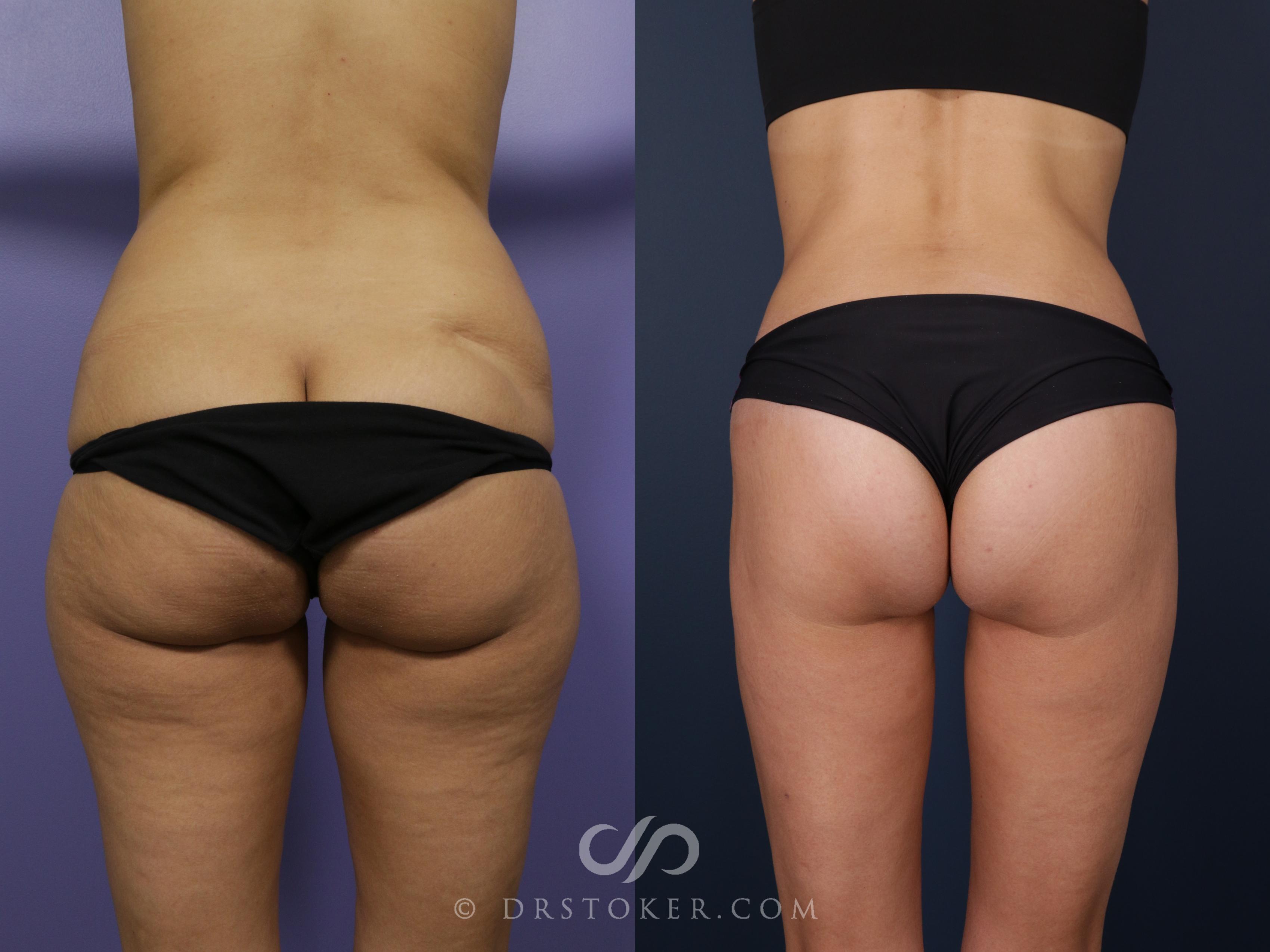 Before & After Bikini Body Lift Case 2383 Back View in Los Angeles, CA