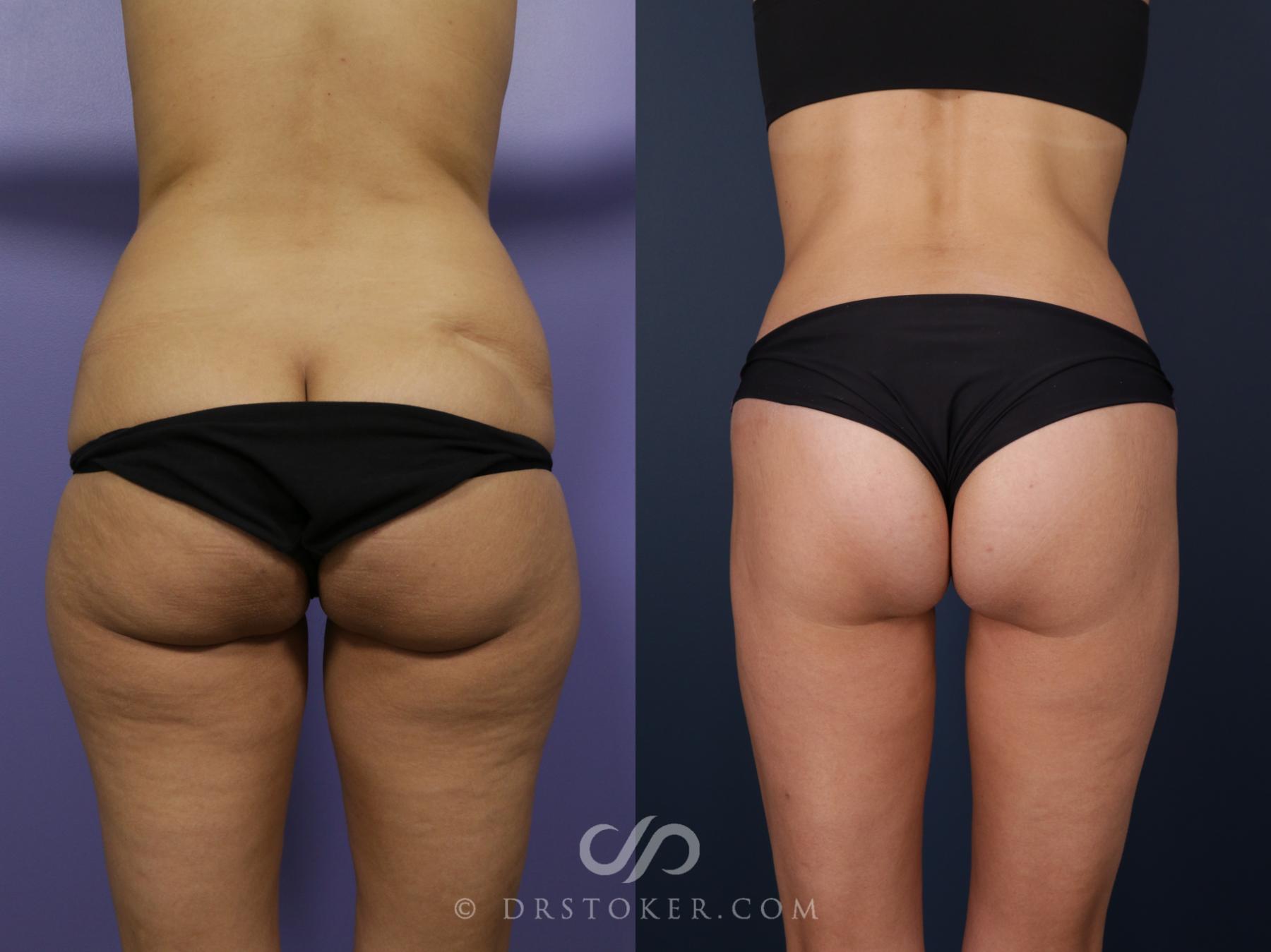 Before & After Bikini Body Lift Case 2383 Back View in Los Angeles, CA