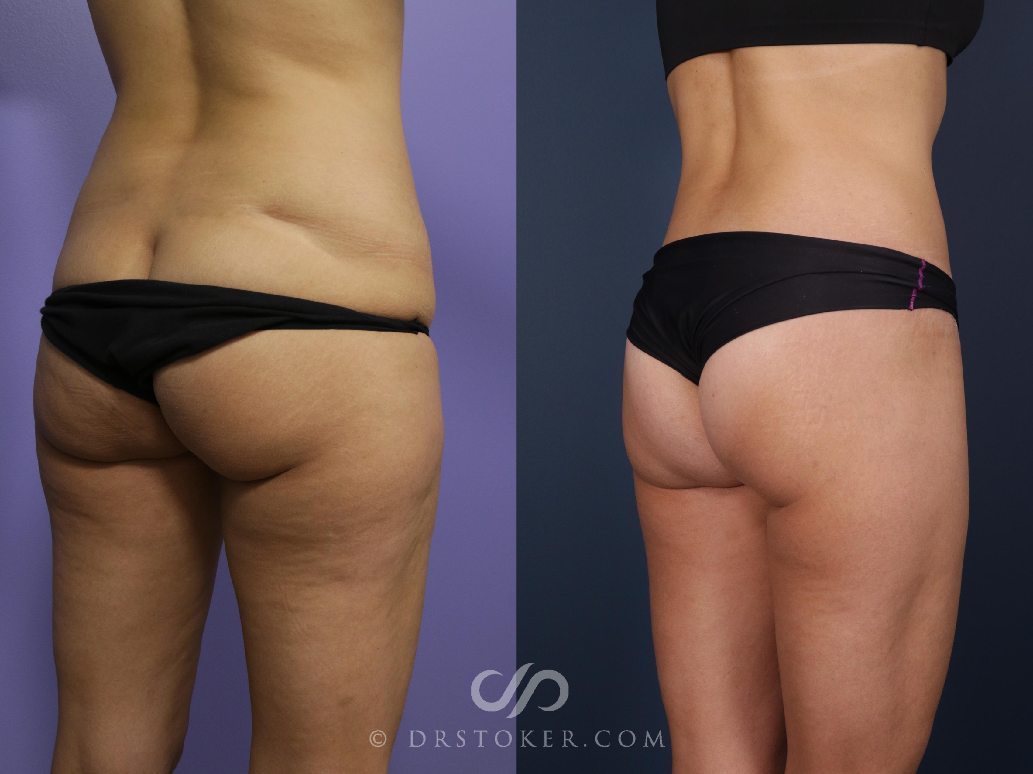 Before & After Bikini Body Lift Case 2383 Right Oblique View in Los Angeles, CA
