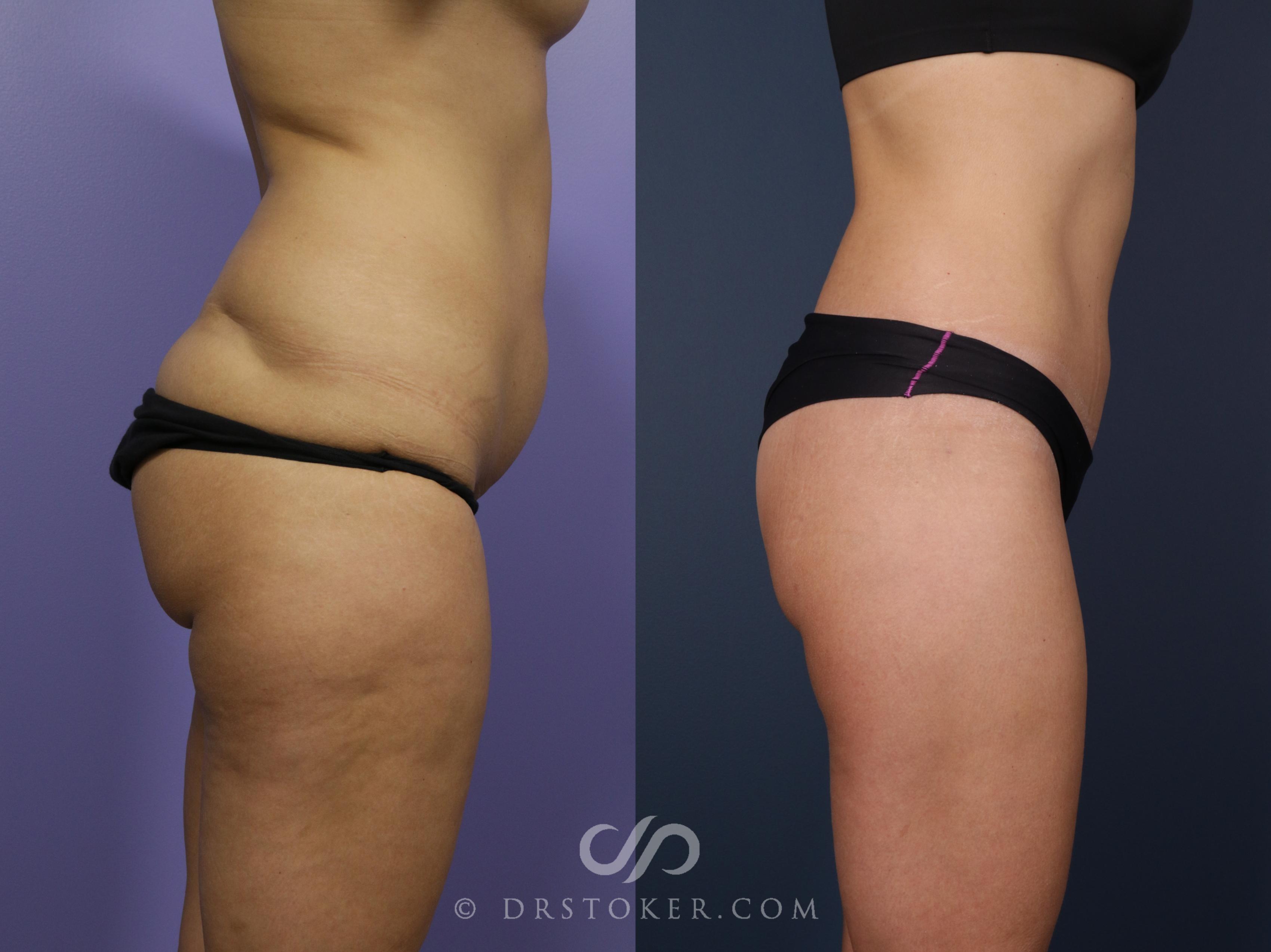 Before & After Bikini Body Lift Case 2383 Right Side View in Los Angeles, CA