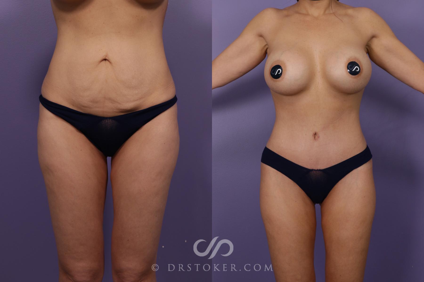 Before & After Lower Body Lift Case 2384 Front View in Los Angeles, CA