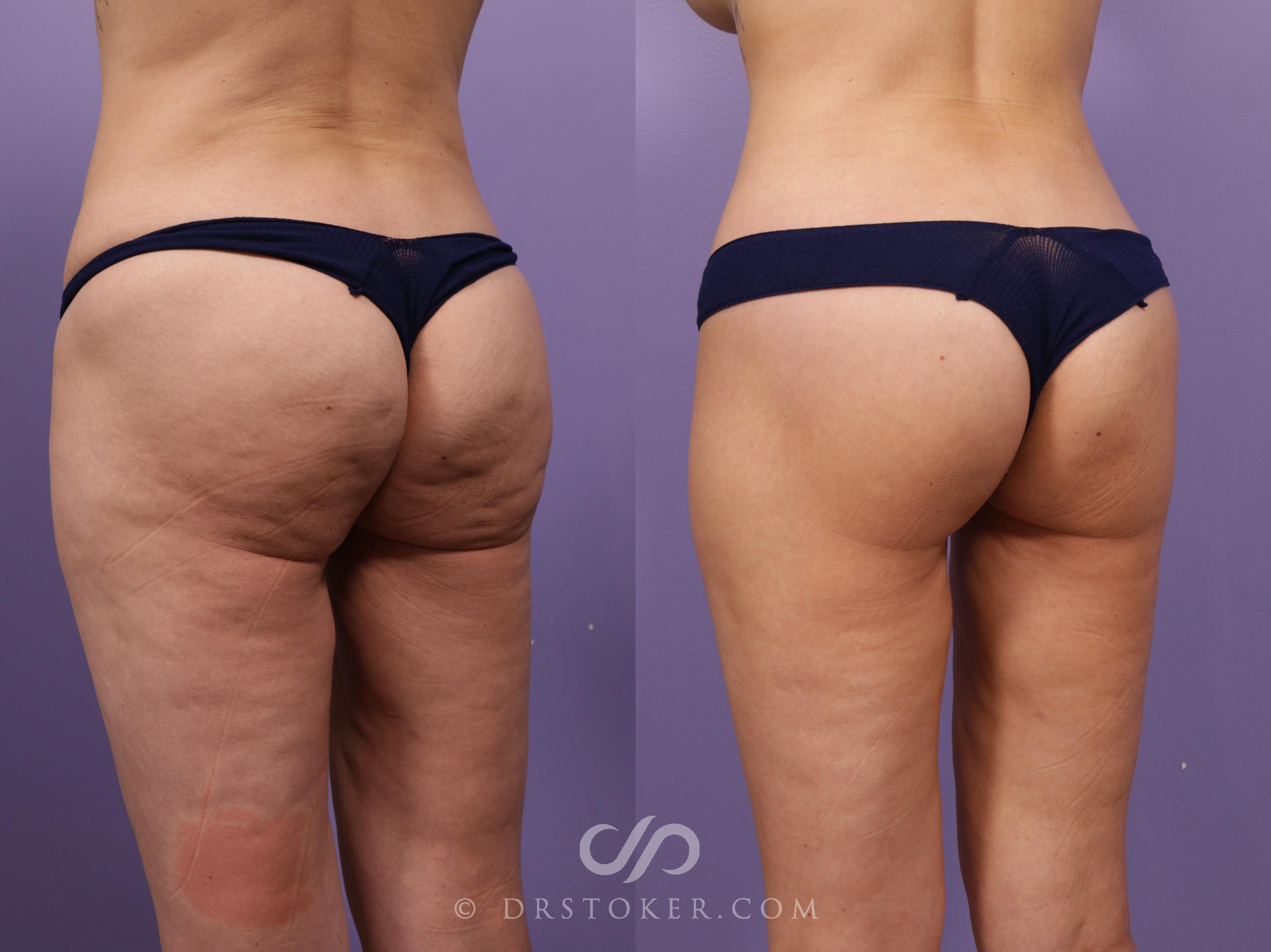 Before & After Lower Body Lift Case 2384 Left Oblique View in Los Angeles, CA