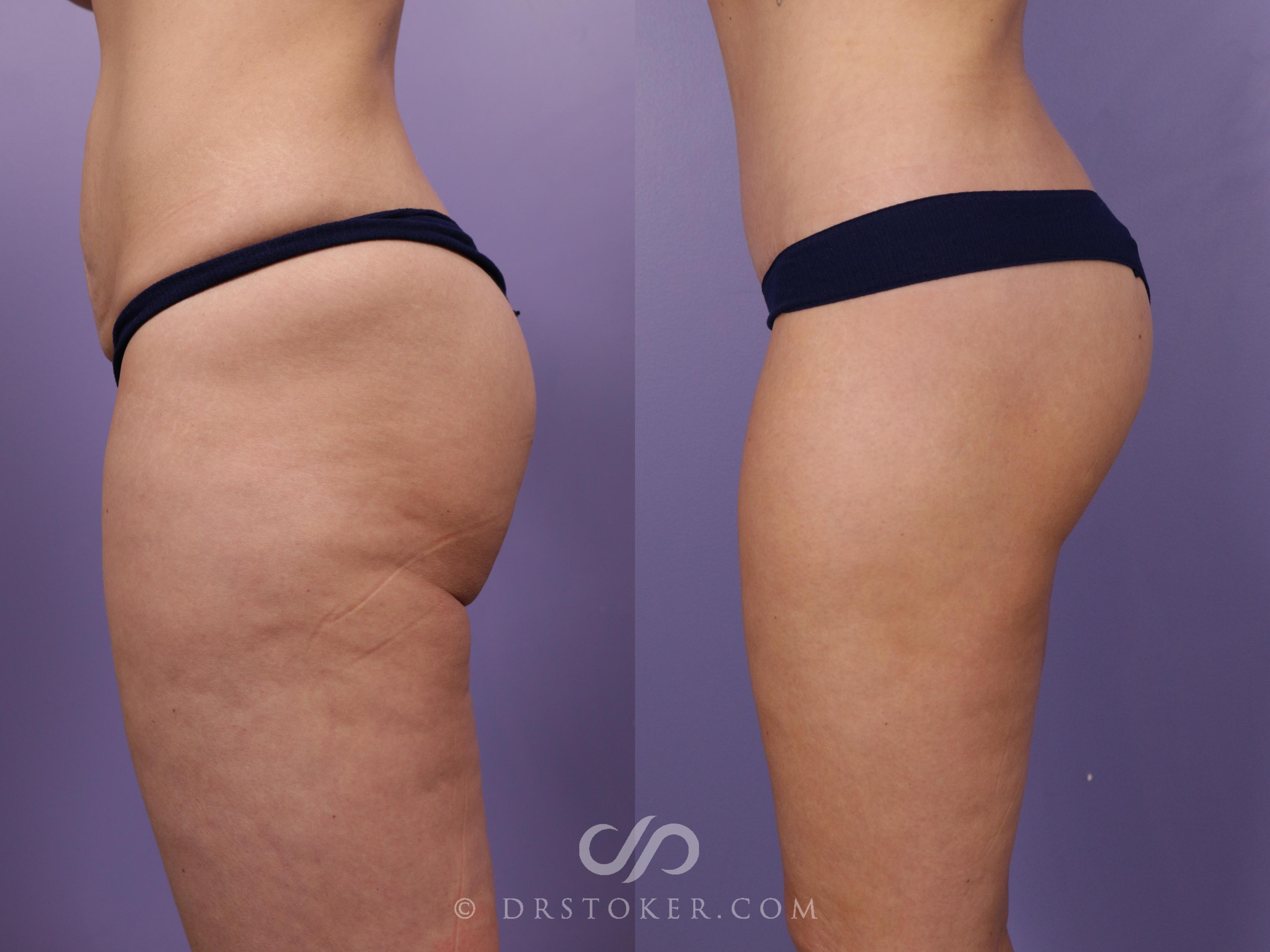 Before & After Lower Body Lift Case 2384 Left Side View in Los Angeles, CA