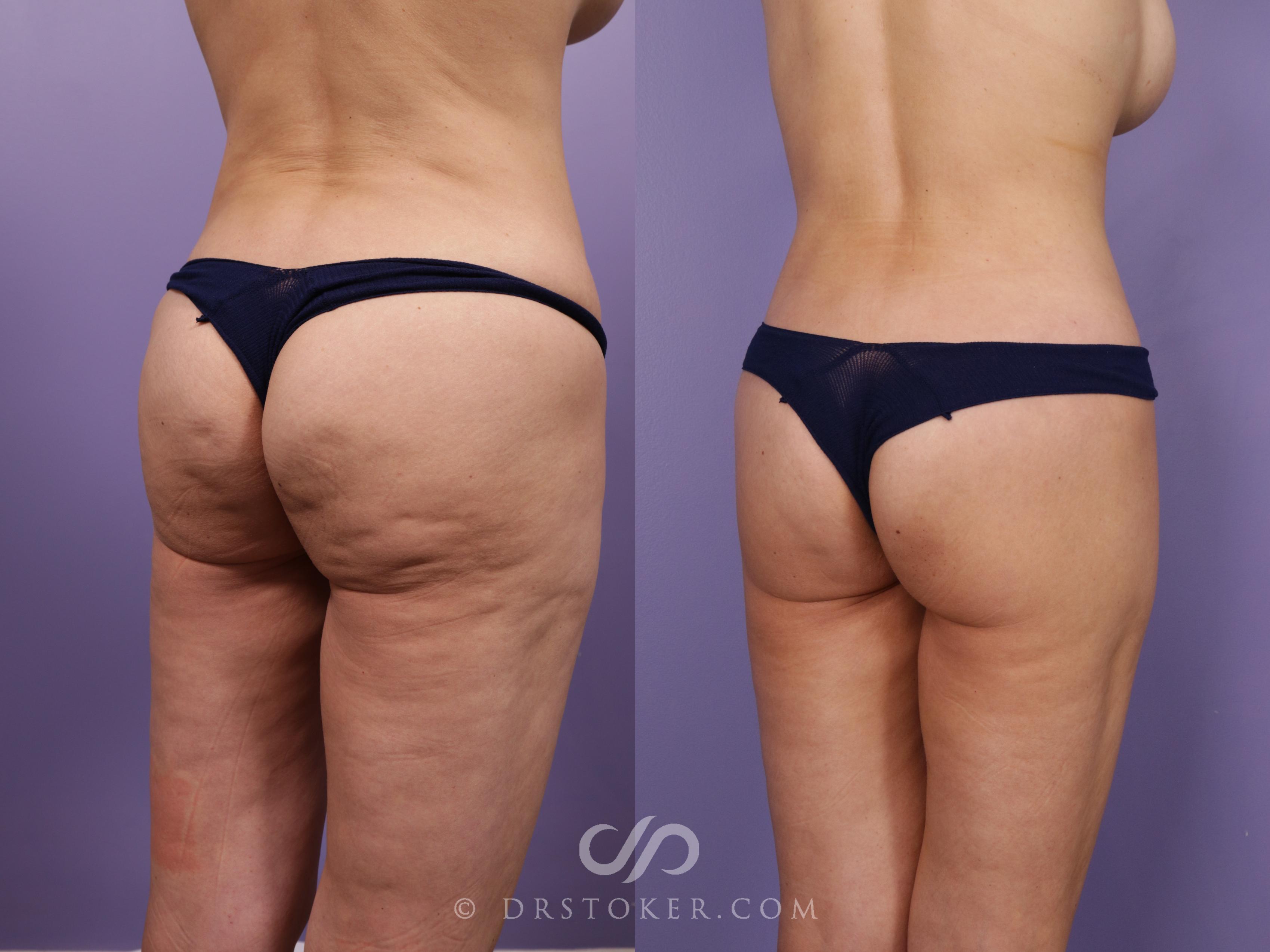 Before & After Lower Body Lift Case 2384 Right Oblique View in Los Angeles, CA