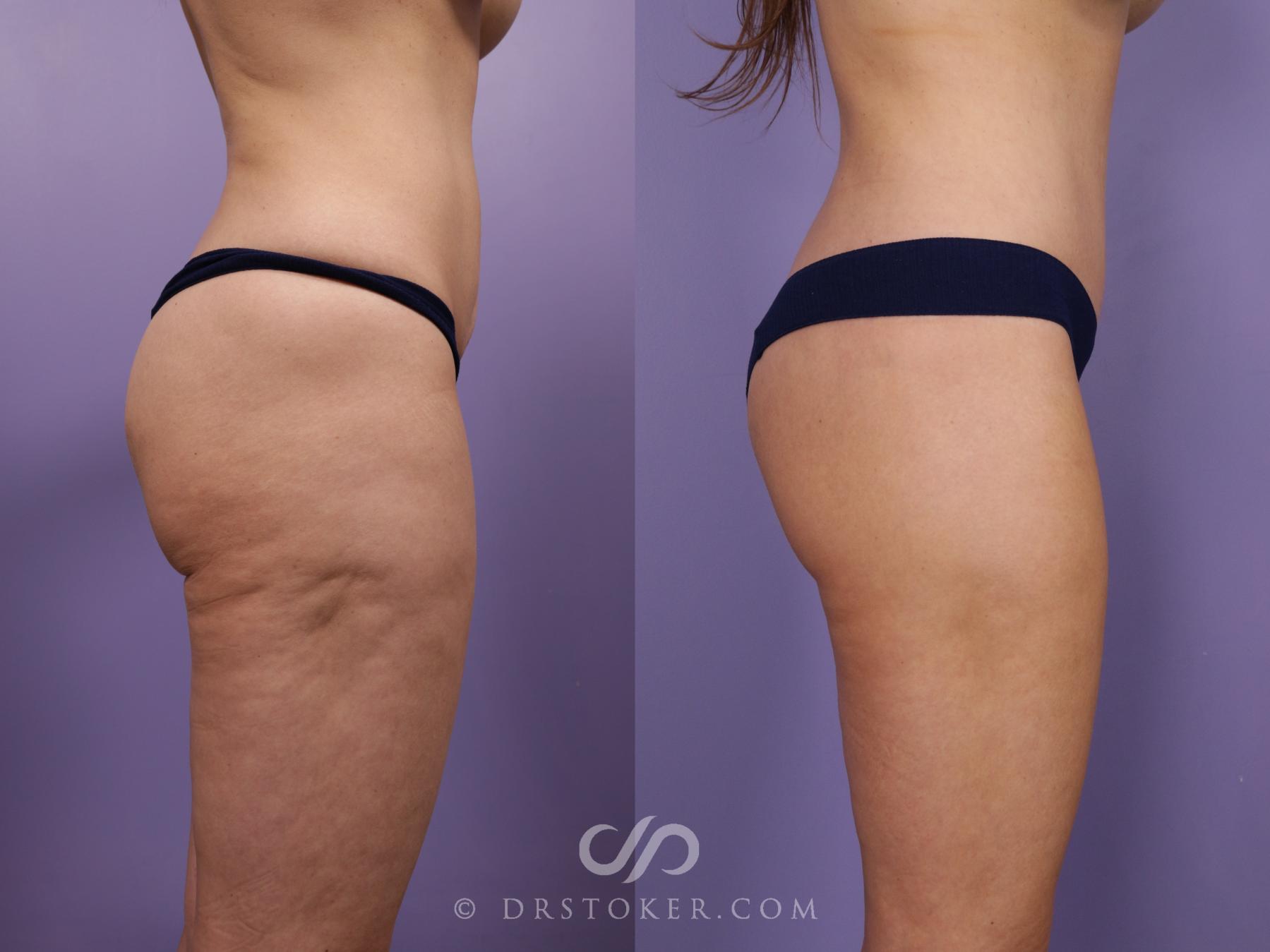Before & After Lower Body Lift Case 2384 Right Side View in Los Angeles, CA