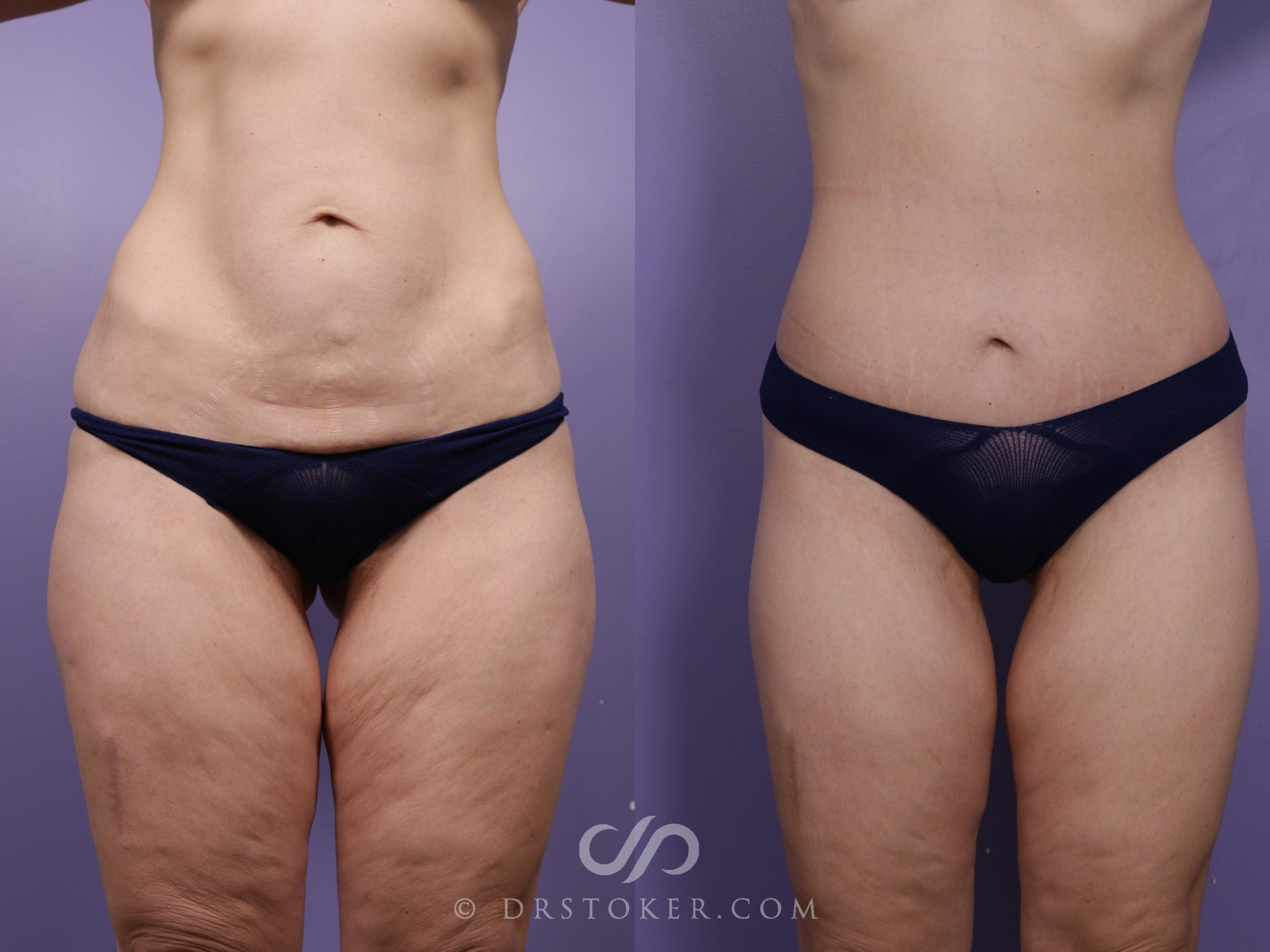 Before & After Lower Body Lift Case 2385 Front View in Los Angeles, CA