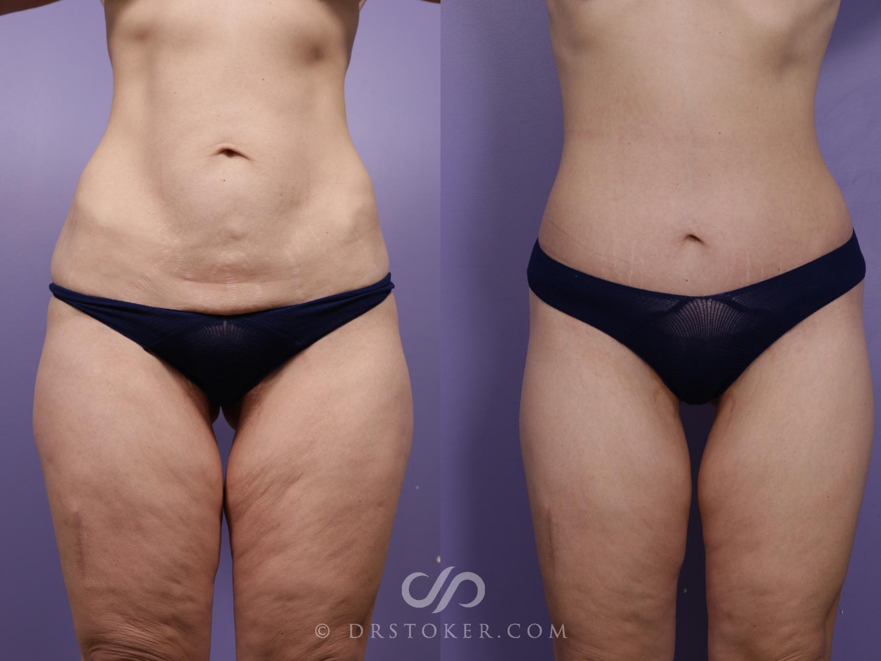 Before & After Lower Body Lift Case 2385 Front View in Los Angeles, CA
