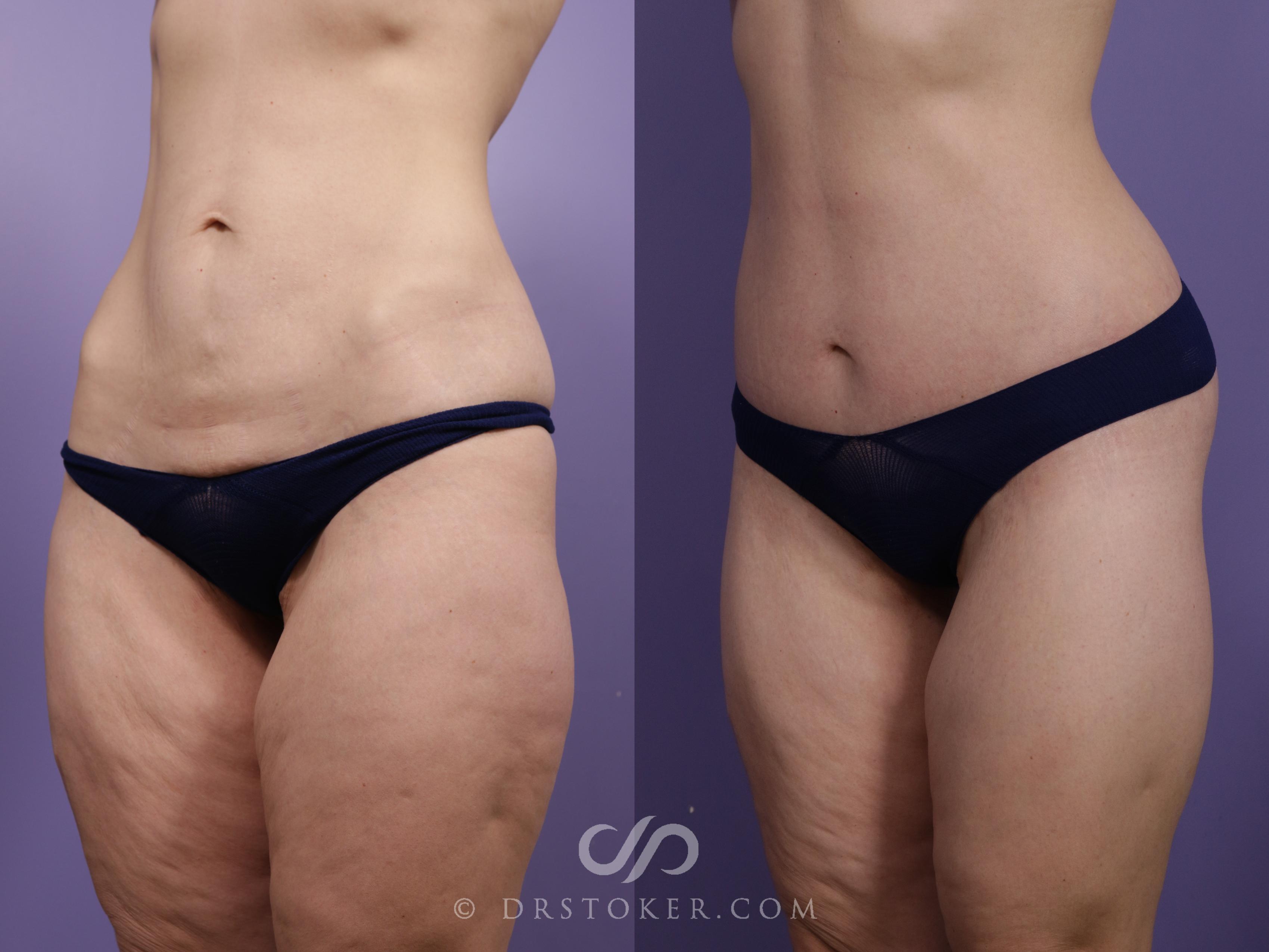 Before & After Lower Body Lift Case 2385 Left Oblique View in Los Angeles, CA