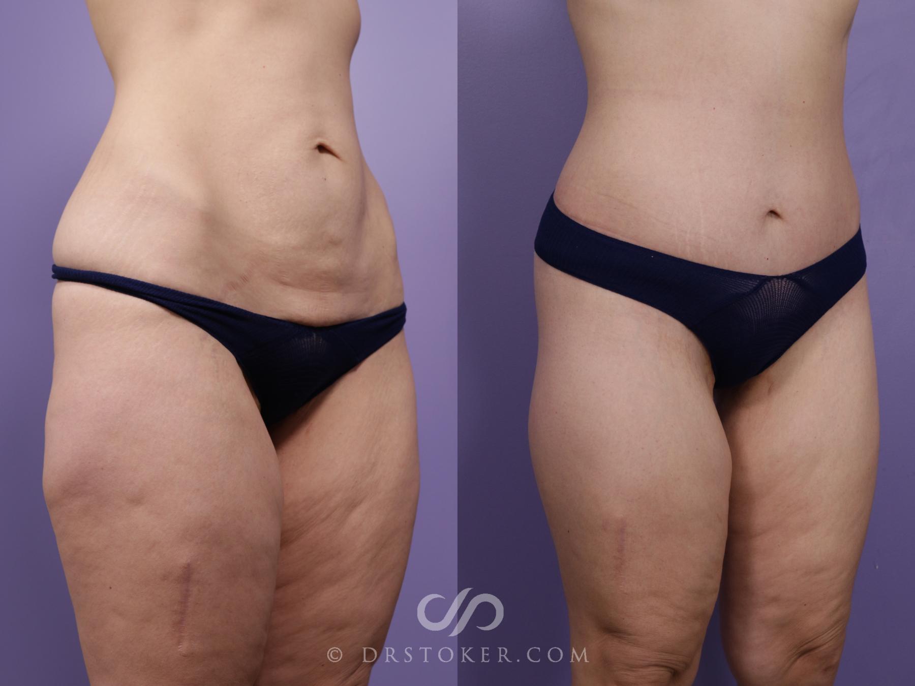 Before & After Lower Body Lift Case 2385 Right Oblique View in Los Angeles, CA