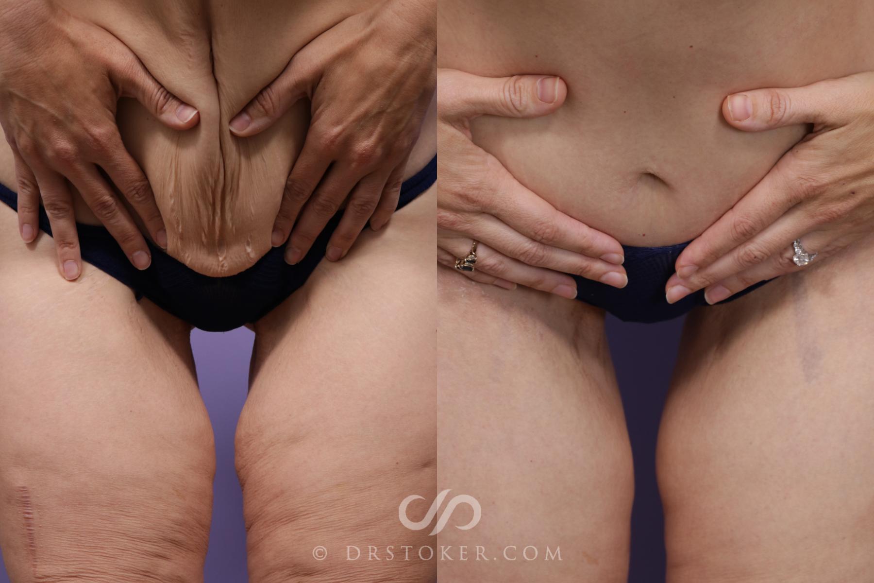 Before & After Lower Body Lift Case 2385 Tight Front View in Los Angeles, CA