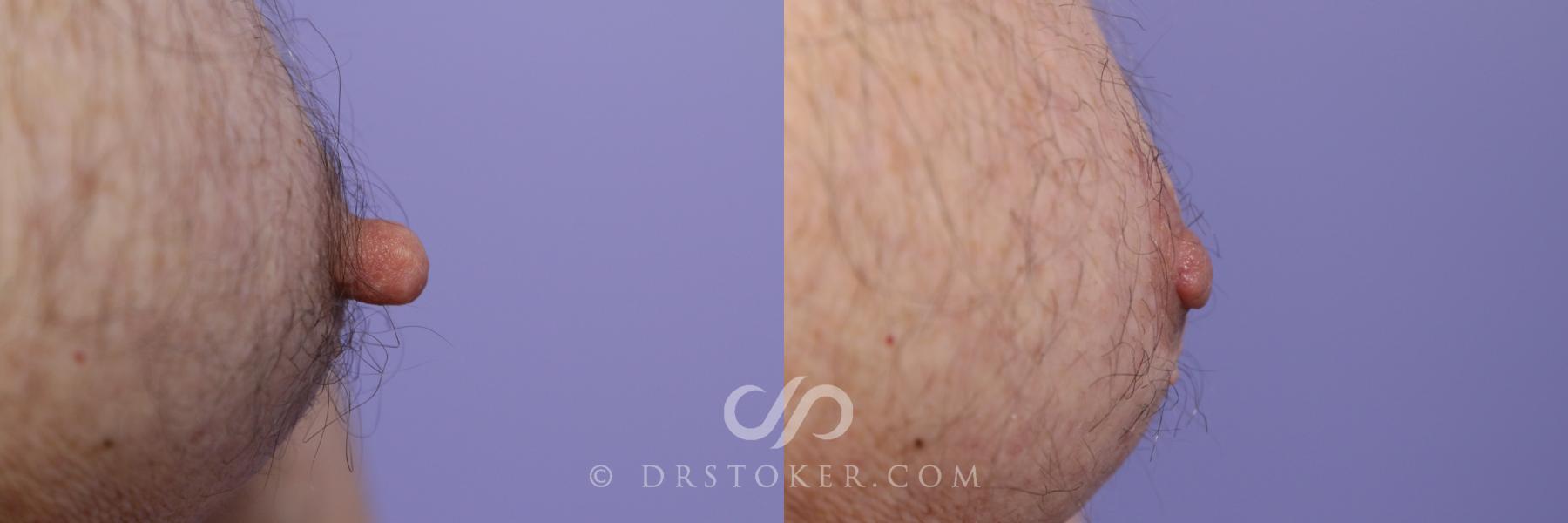 Before & After Male Nipple Reduction Case 1214 View #1 View in Los Angeles, CA
