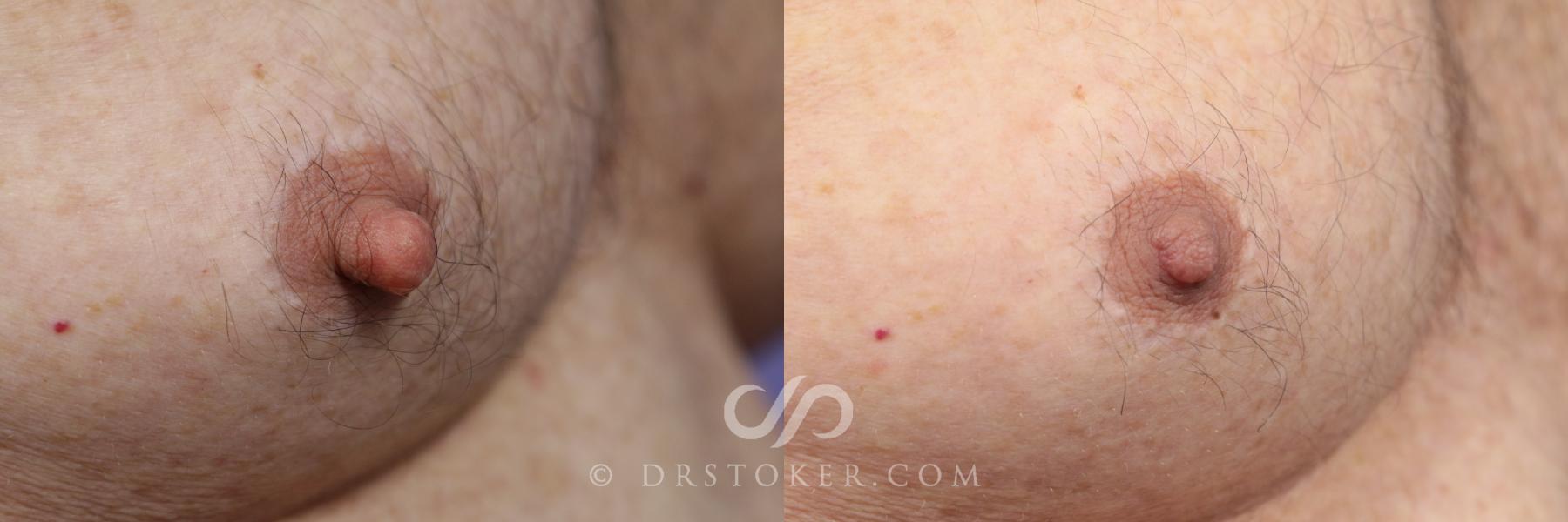 Before & After Male Nipple Reduction Case 1215 View #1 View in Los Angeles, CA