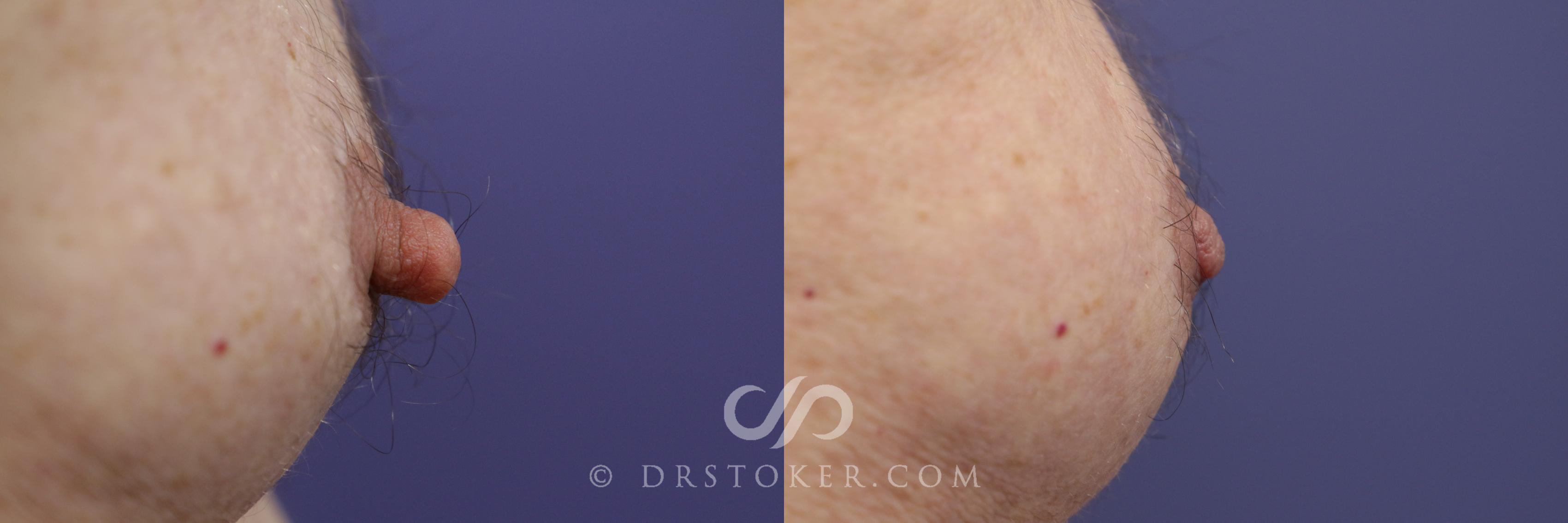 Before & After Male Nipple Reduction Case 1216 View #1 View in Los Angeles, CA
