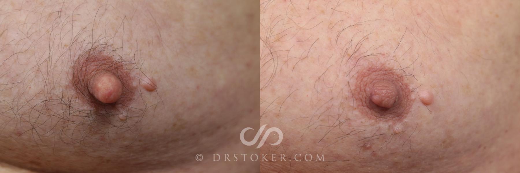 Before & After Male Nipple Reduction Case 1217 View #1 View in Los Angeles, CA