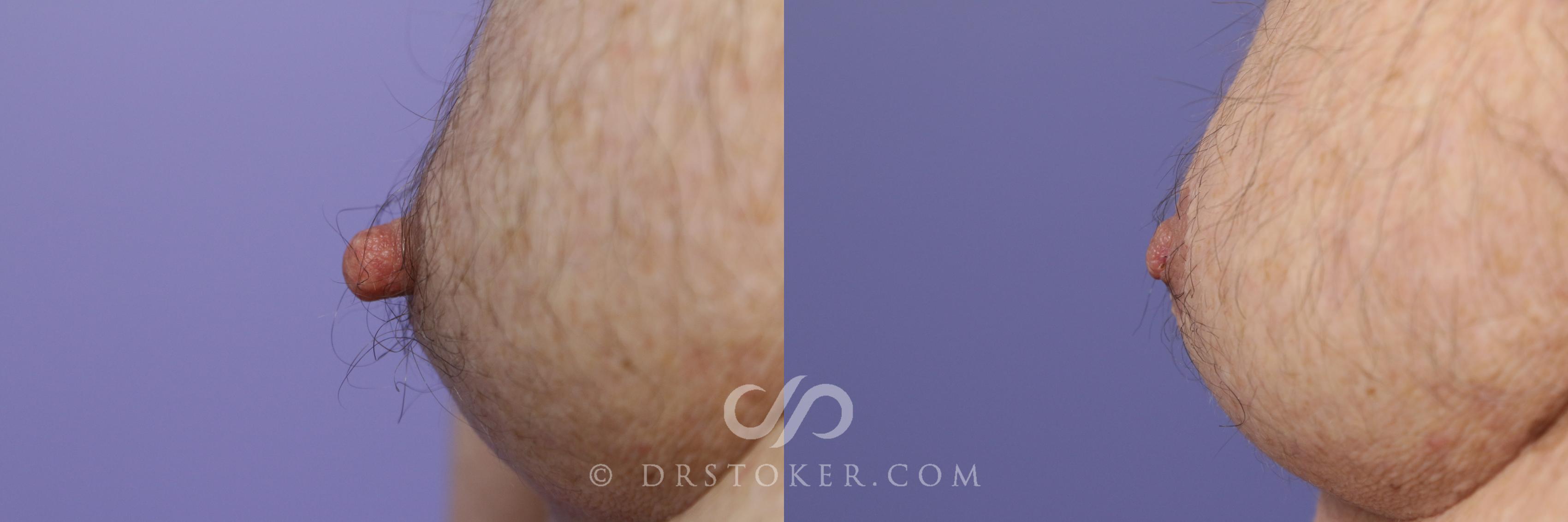 Before & After Male Nipple Reduction Case 1219 View #1 View in Los Angeles, CA