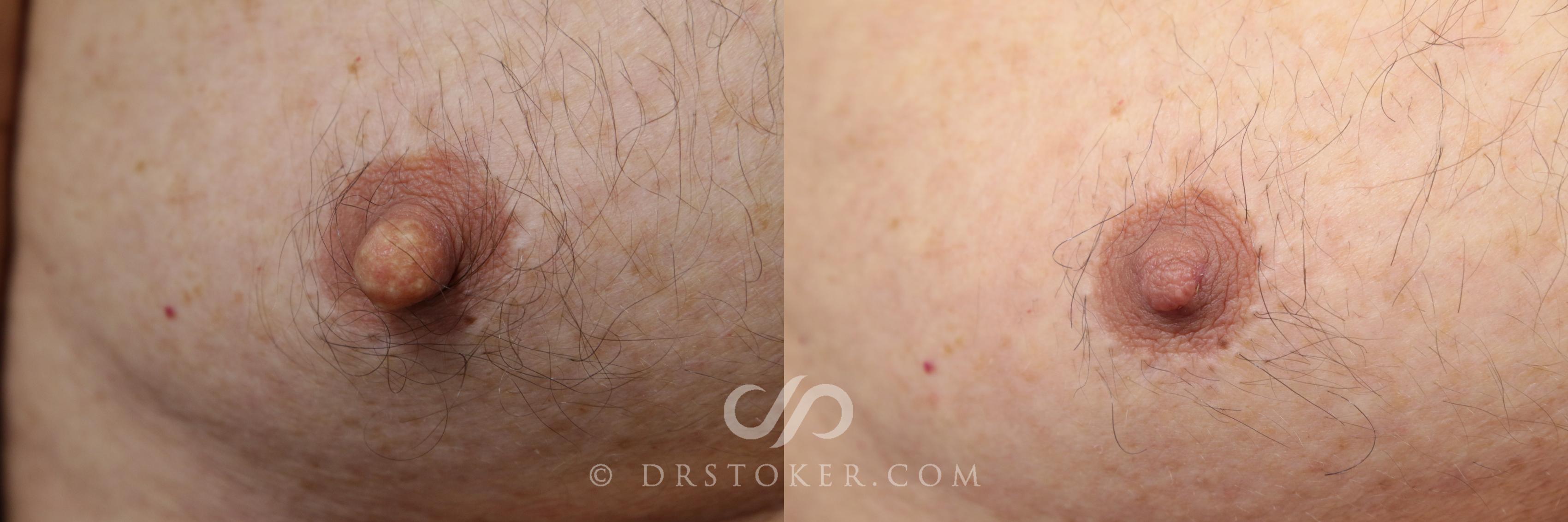 Before & After Male Nipple Reduction Case 1220 View #1 View in Los Angeles, CA