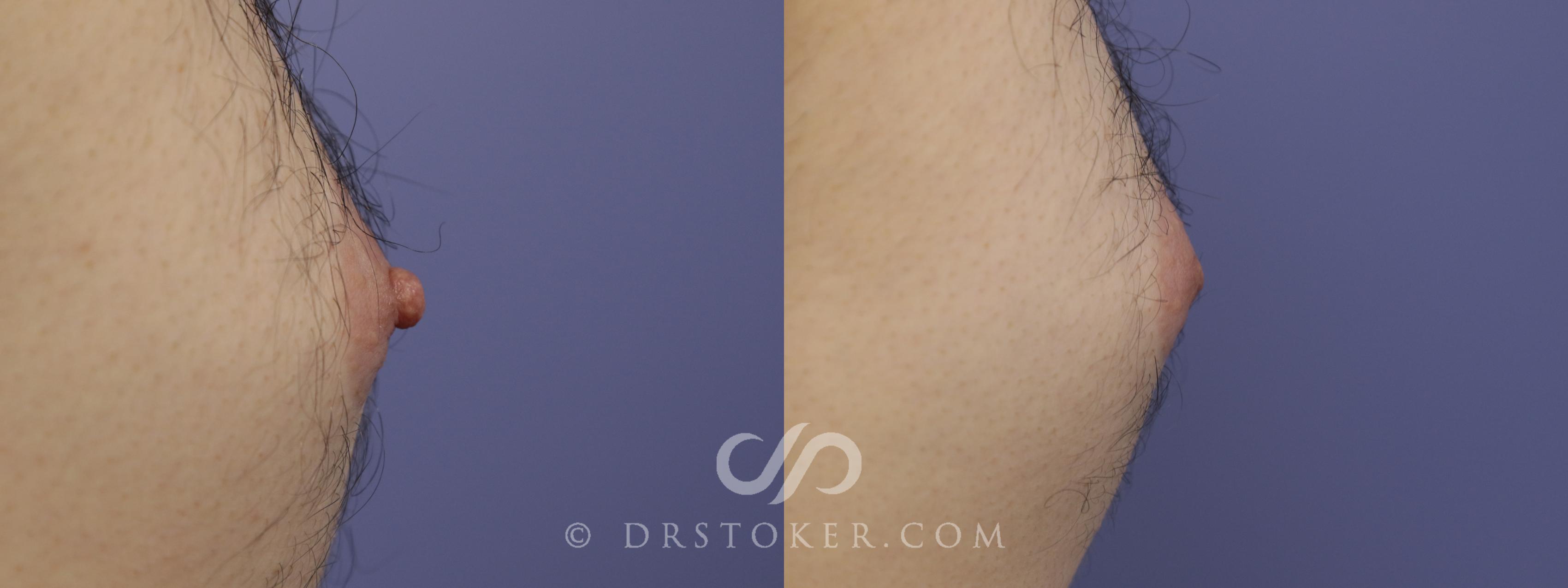 Before & After Male Nipple Reduction Case 1221 View #1 View in Los Angeles, CA