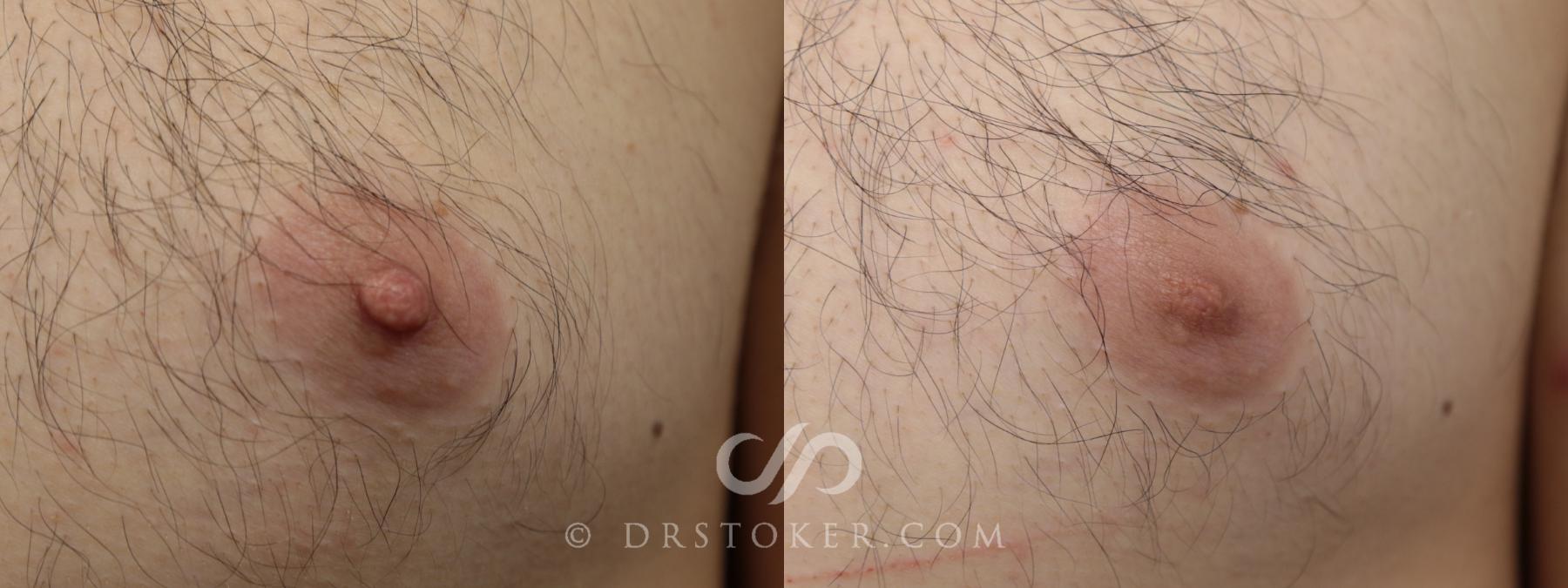 Before & After Male Nipple Reduction Case 1222 View #1 View in Los Angeles, CA