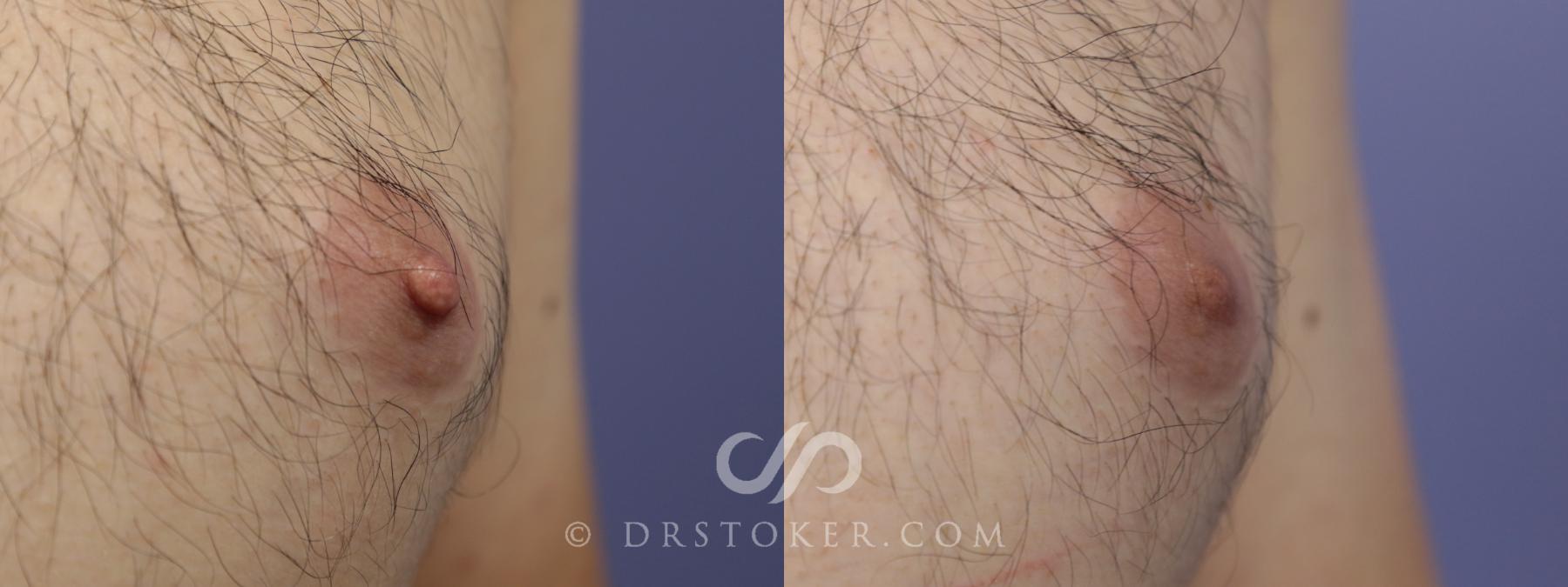 Before & After Male Nipple Reduction Case 1223 View #1 View in Los Angeles, CA