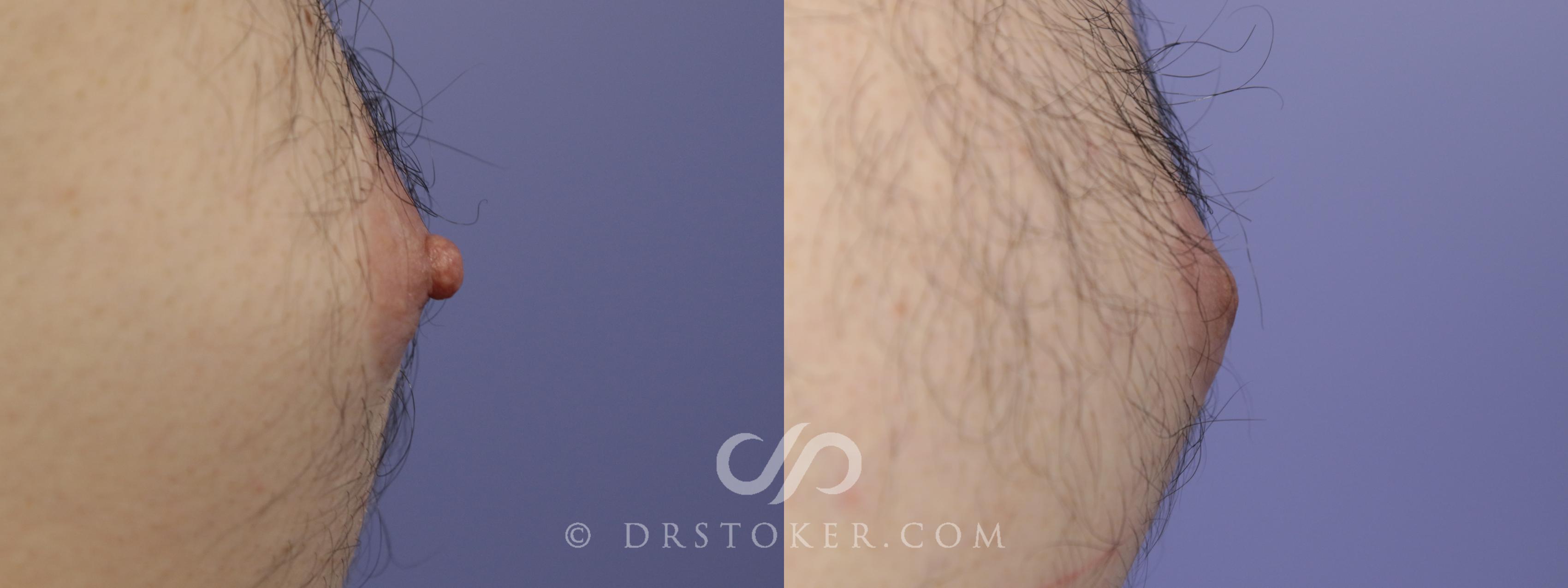 Before & After Male Nipple Reduction Case 1224 View #1 View in Los Angeles, CA