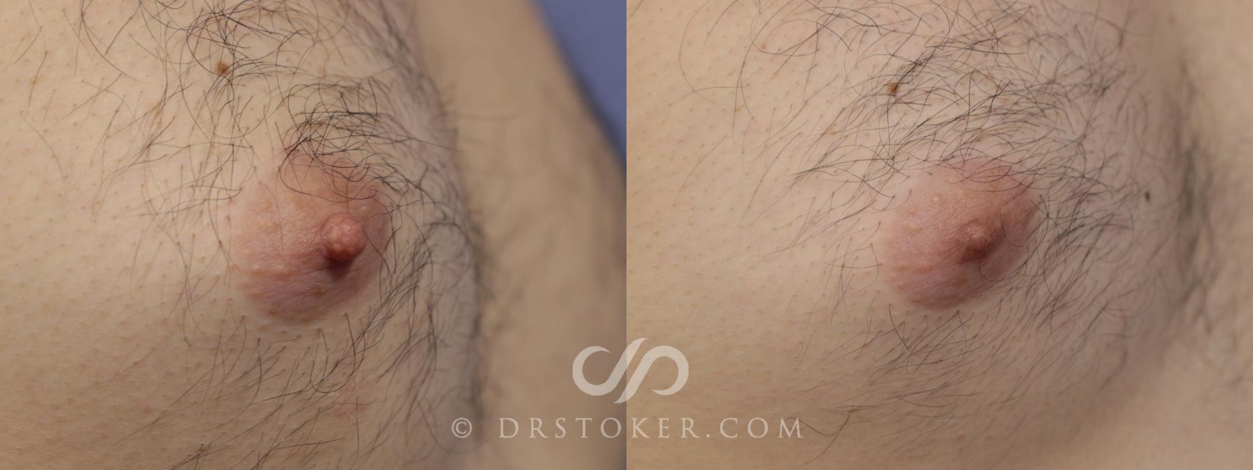 Before & After Male Nipple Reduction Case 1225 View #1 View in Los Angeles, CA