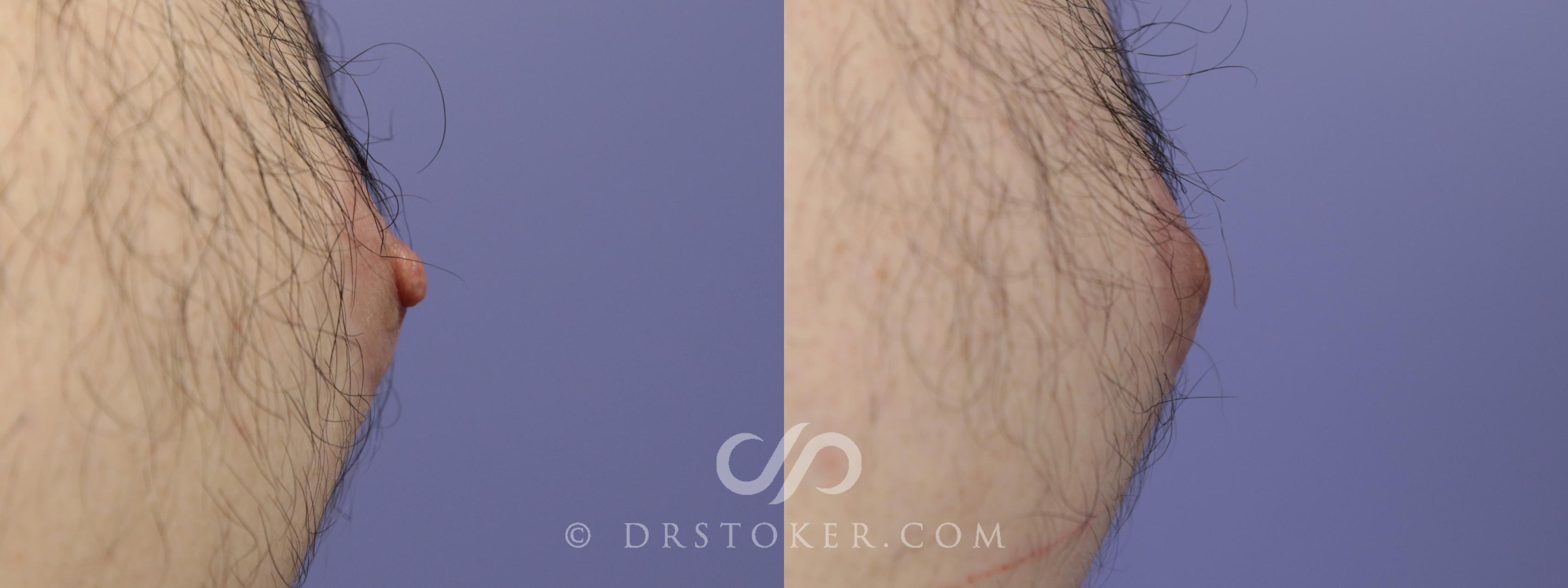 Before & After Male Nipple Reduction Case 1226 View #1 View in Los Angeles, CA