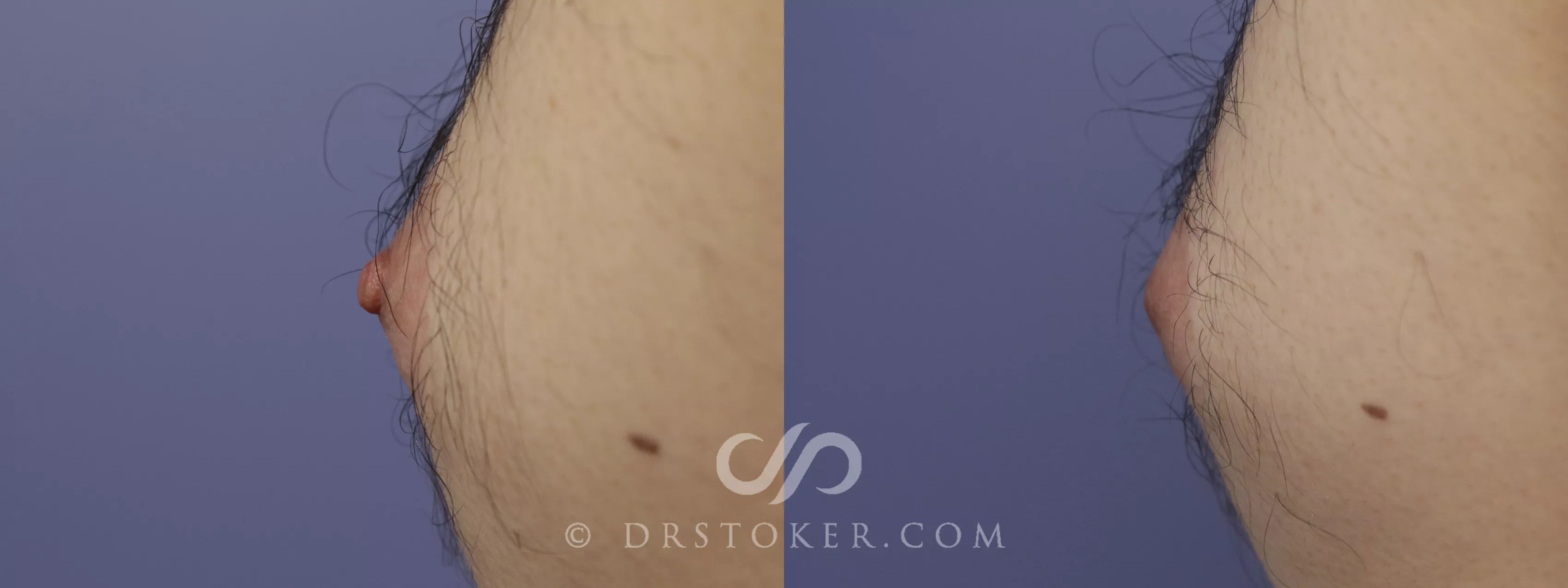 Male Nipple Reduction Before and After Pictures Case 1227, Los Angeles, CA