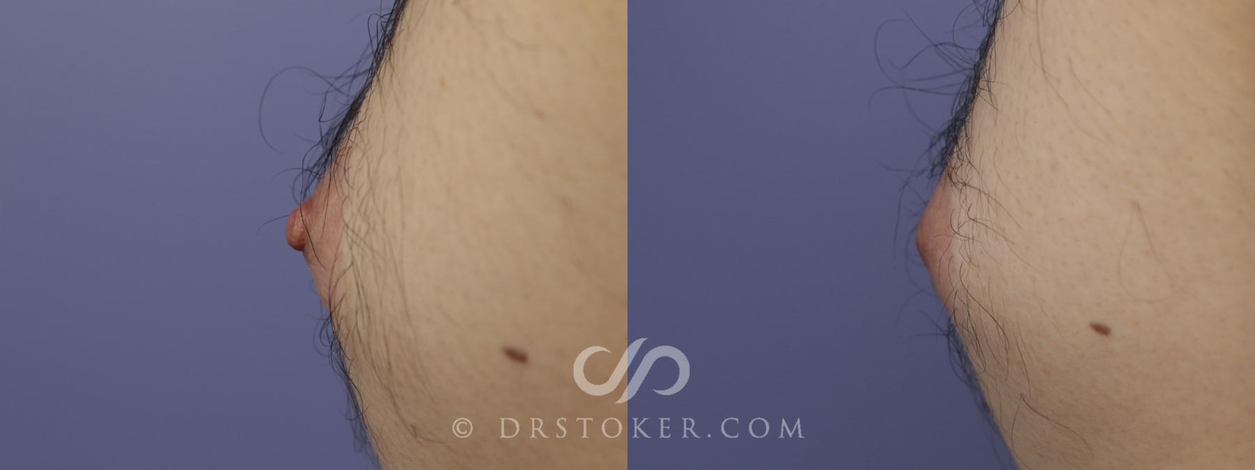 Before & After Male Nipple Reduction Case 1227 View #1 View in Los Angeles, CA