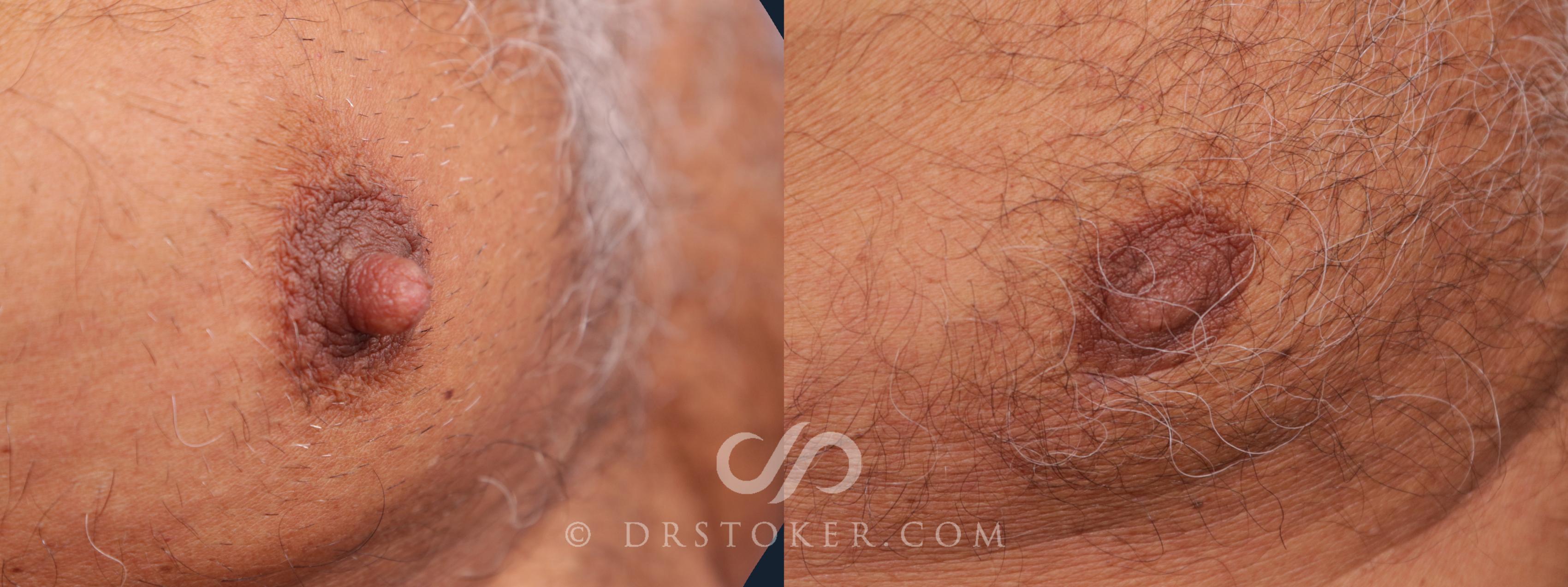 Before & After Male Nipple Reduction Case 2010 Right Oblique View in Los Angeles, CA