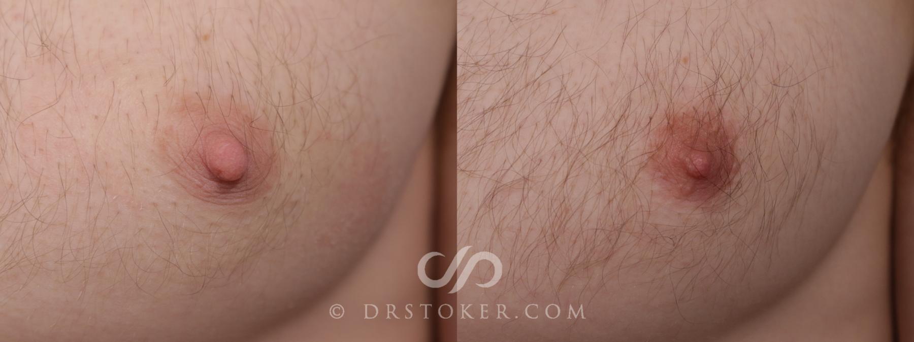 Before & After Male Nipple Reduction Case 2170 Left Side View in Los Angeles, CA