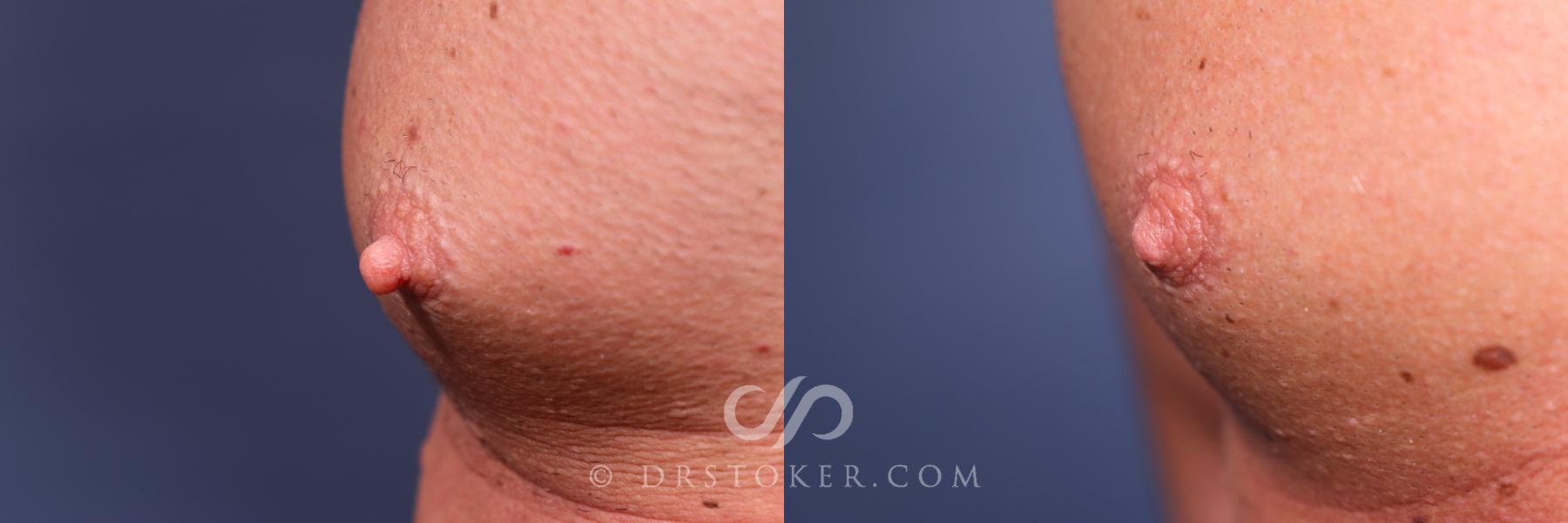 Before & After Male Nipple Reduction Case 2643 Right Oblique View in Los Angeles, CA
