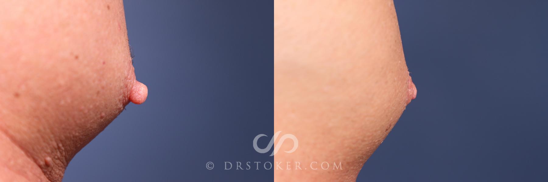 Before & After Male Nipple Reduction Case 2643 Right Tight View in Los Angeles, CA