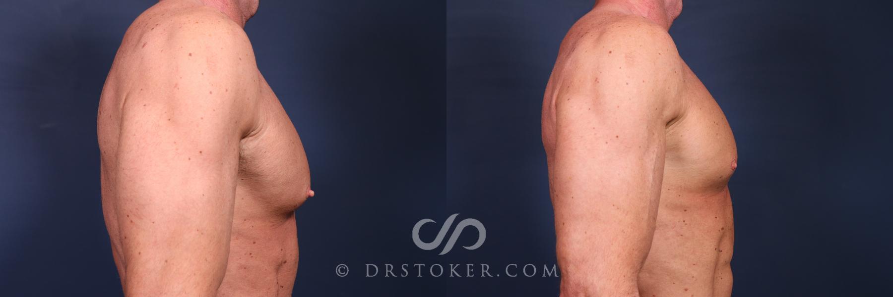 Before & After Male Nipple Reduction Case 2644 Left Side View in Los Angeles, CA