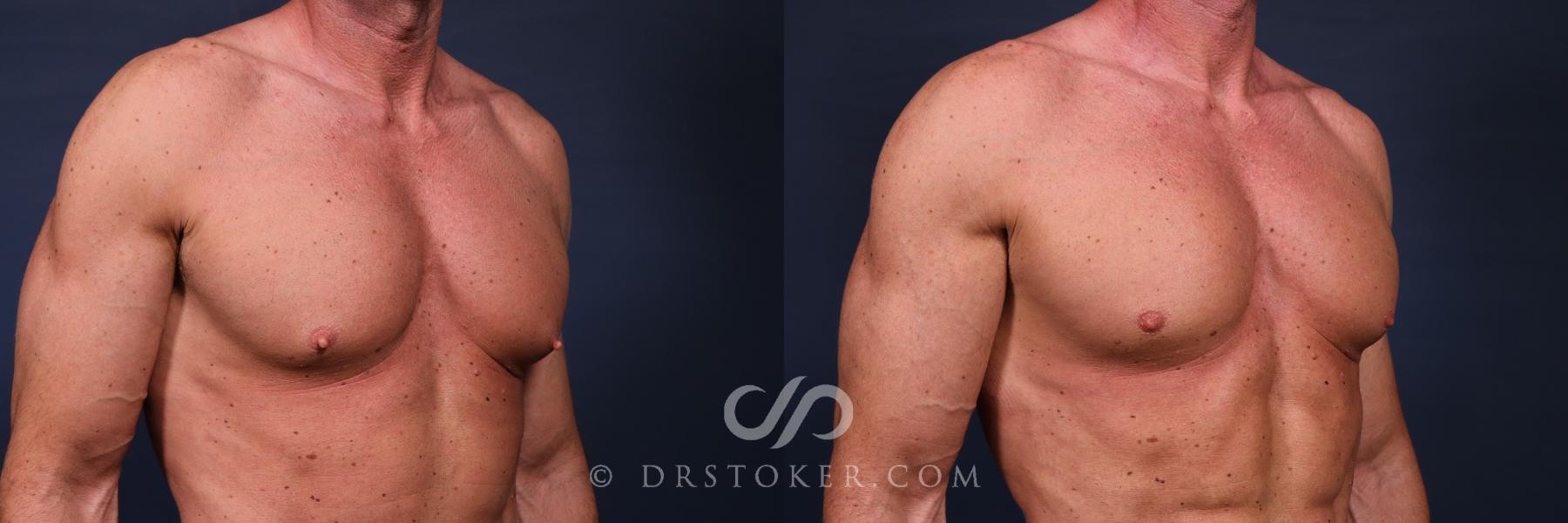 Before & After Male Nipple Reduction Case 2644 Right Oblique View in Los Angeles, CA