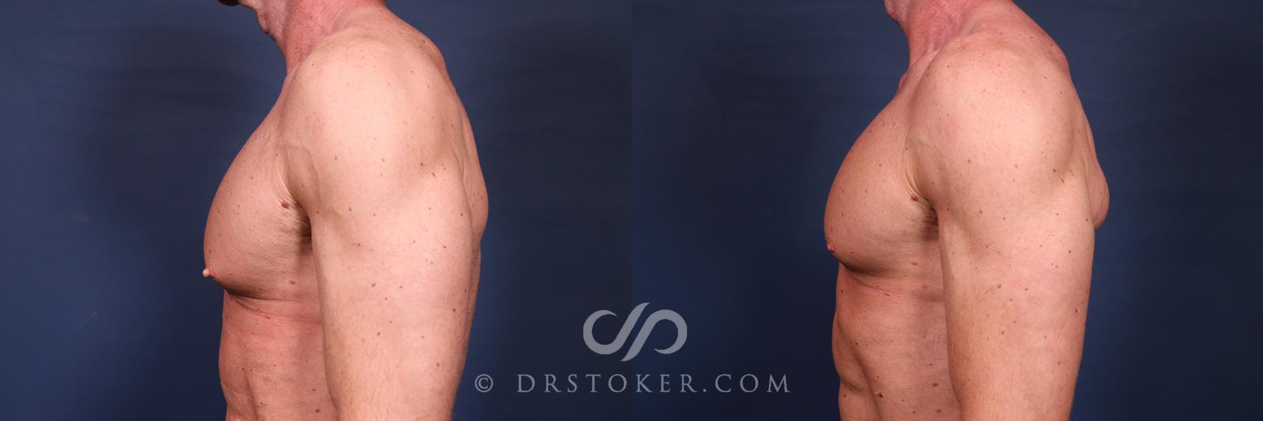 Before & After Male Nipple Reduction Case 2645 Left full View in Los Angeles, CA