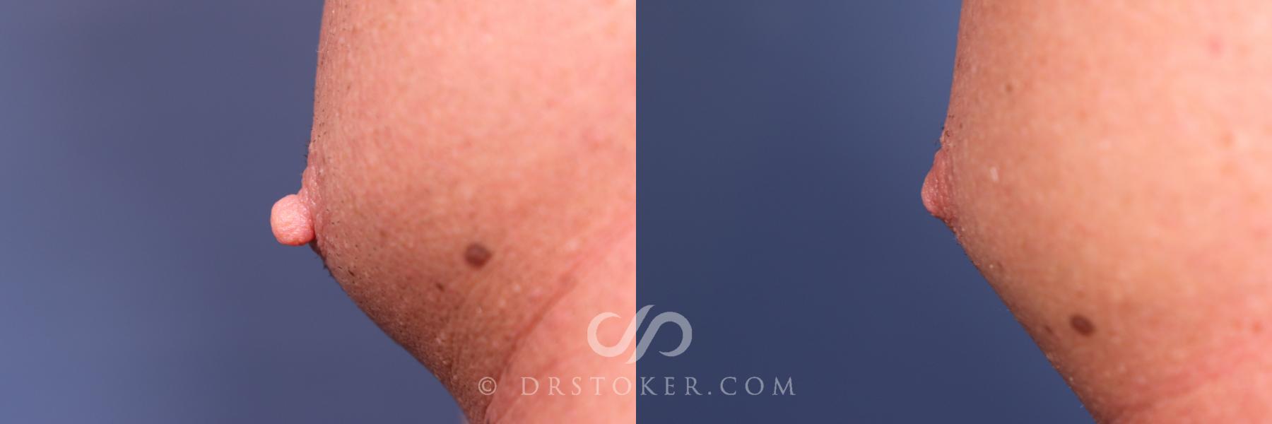 Before & After Male Nipple Reduction Case 2645 Left Oblique View in Los Angeles, CA